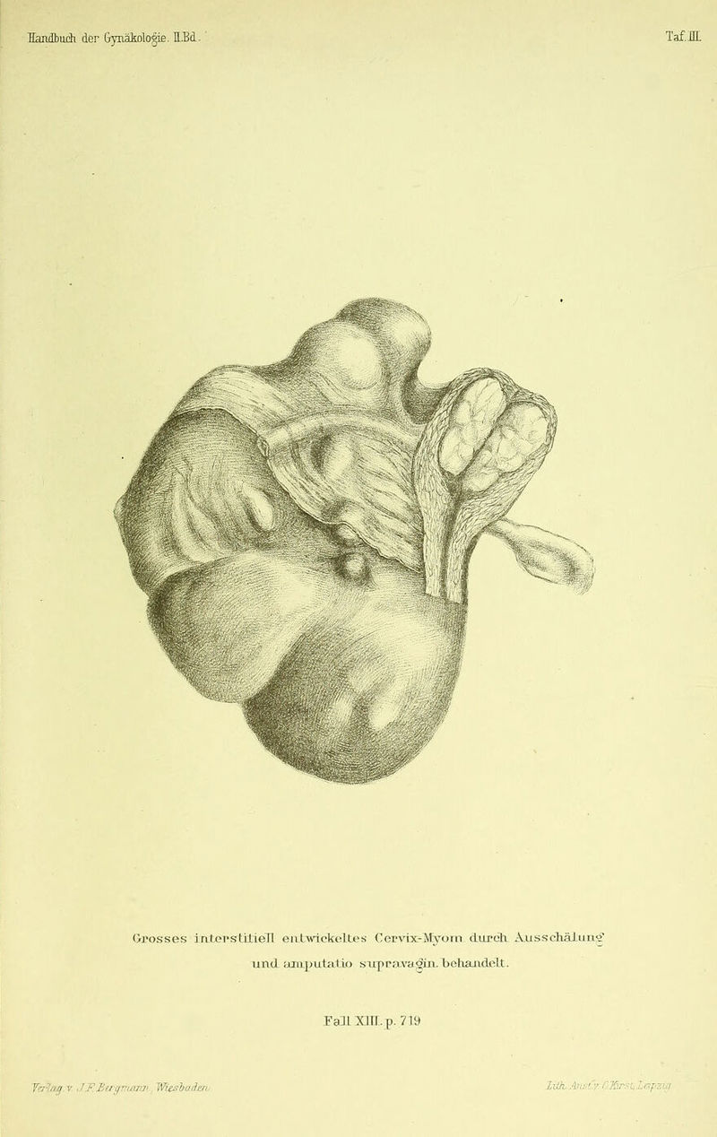 Grosses 3 atopstilieH en twickeltes Cervix-Myom durch Ausschälung und amputatLo supravagin. behandelt. Ealt Xlll.p. 719 Tabigv J.F.Btrgmwm WitsbaBen-. Sith. AjuHv t.'..Jßrsulapzig