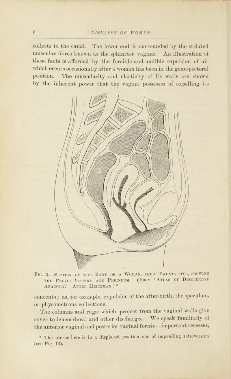 collects ill the canal. The lower end is surrounded by the striated muscular fibres known as the sphincter vaginae. An illustration of these facts is afforded by the forcible and audible expulsion of air which occurs occasionally after a woman has been in the genu-pectoral position. The muscularity and elasticity of its walls are shown by the inherent power that the vagina possesses of expelling its Fig. 3.—Sectiox THE Pelvic Anatomy.’ ()E THE Body or a omax, aged ’1 wenty-fiye, sshoving Yisceua and Peiuneitm. (From ‘Atlas of Descriptive After Heitzman.) * contents; as, for example, expulsion of the after-birth, the speculum, or physometrous collections. The columns and rugie which project from the vaginal walls give cover to leucorrhceal and other discharges. We speak familiarly of the anterior vaginal and posterior vaginal fornix—important recesses, * ’I'liG uterus here is in a (see Fig. 13). displaced position, one of impending retroversion