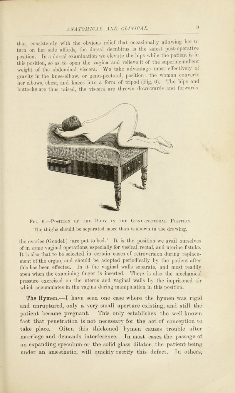 I) that, consistently with the obvious relief that occasionally allowing her to turn on her side affords, the dorsal decubitus is the safest post-operative position. In a dorsal examination wo elevate the hips while the patient is in this position, so as to open the vagina and relieve it of the superincumbent weight of the abdominal viscera. We take advantage most effectively of gravity in the knee-elbow, or genu-pectoral, position : the woman converts her elbows, chest, and knees into a form of tripod (Fig. 6). Ihe hips and buttocks arc thus raised, the viscera ai'e thrown downwards and forwards P'k;. (j.—Position of tuk Body in ihk (iKNU-rKcroitAL Position. 'J'he thighs should be separated more than is shown in the drawing. the ovaries (Goodell) ‘are put to bed.’ It is the position we avail ourselves of in some vaginal operations, especially for vesical, rectal, and uterine fistulie. It is also that to be selected in certain cases of retroversion during replace- ment of the organ, and should be adopted periodically by the patient after this has been effected. In it the vaginal walls separate, and most readily open when the examining finger is inserted. The^e is also the mechanical pressure exercised on the uterus and vaginal walls by the imprisoned air wdiich accumulates in the vagina during manipulation in this position. The Hymen.—I have seen one case where the hymen was rigid and unruptured, only a very small aperture existing, and still the patient became pregnant. This only establishes the wmll-known fact that penetration is not necessary for the act of conception to take place. Often this thickened hymen causes trouble after marriage and demands interference. In most cases the passage of an expanding speculum or the solid glass dilator, the patient being under an anaesthetic, will quickly rectify this defect. In others.