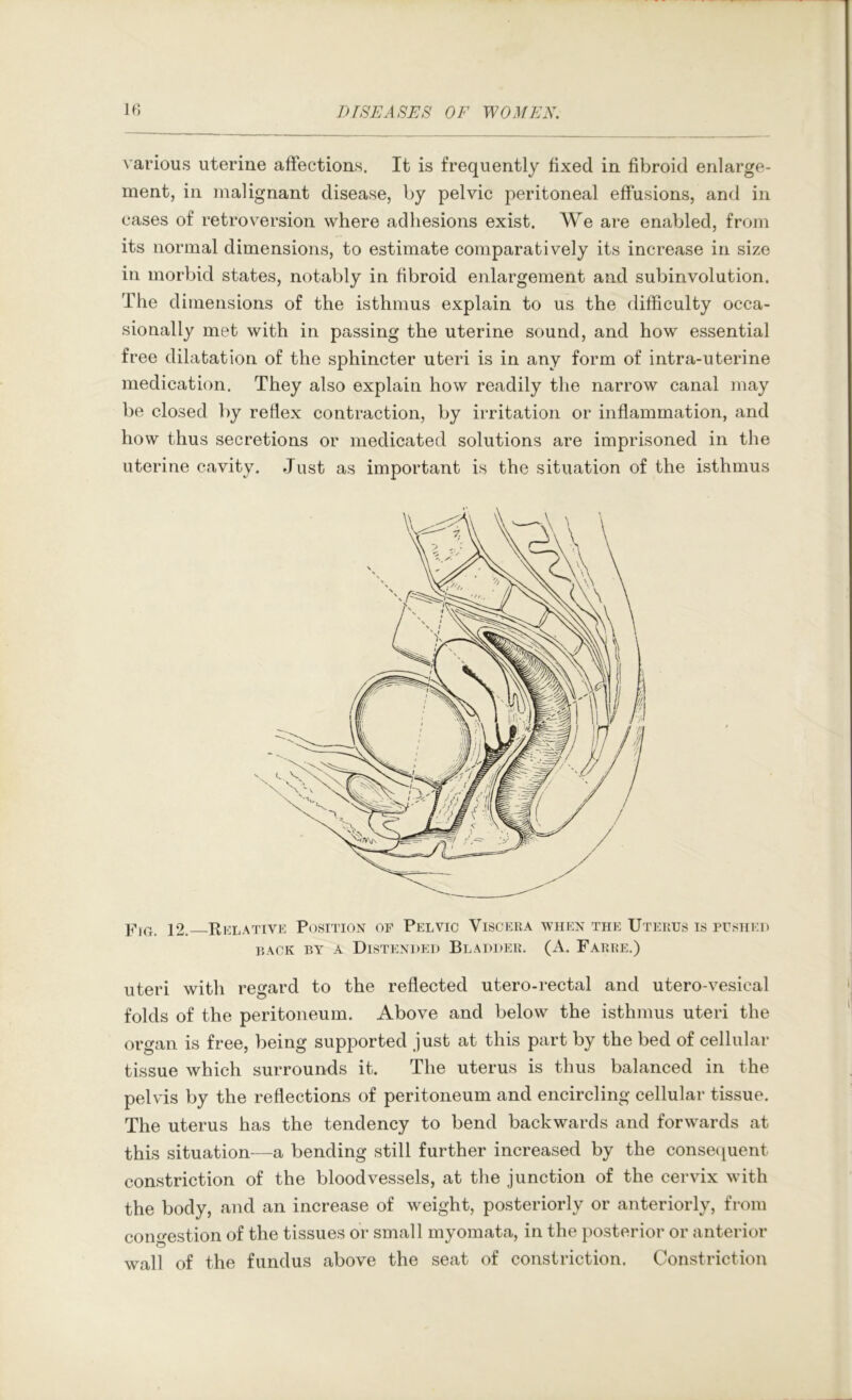 various uterine affections. It is frequently fixed in fibroid enlarge- ment, in malignant disease, by pelvic peritoneal effusions, and in cases of retroversion where adhesions exist. We are enabled, from its normal dimensions, to estimate comparatively its increase in size in morbid states, notably in fibroid enlargement and subinvolution. The dimensions of the isthmus explain to us the difficulty occa- sionally met with in passing the uterine sound, and how essential free dilatation of the sphincter uteri is in any form of intra-uterine medication. They also explain how readily the narrow canal may be closed by reflex contraction, by irritation or inflammation, and how thus secretions or medicated solutions are imprisoned in the uterine cavity. Just as important is the situation of the isthmus Pif}, ]2. Relative Position of Pelvic Visceiia when the Uterus is pusiiei) RACK BY A Distended Bladder. (A. Farre.) uteri with regard to the reflected utero-rectal and utero-vesical folds of the peritoneum. Above and below the isthmus uteri the organ is free, being supported just at this part by the bed of cellular tissue which surrounds it. The uterus is thus balanced in the pelvis by the reflections of peritoneum and encircling cellular tissue. The uterus has the tendency to bend backwards and forwards at this situation—a bending still further increased by the conseciuent constriction of the bloodvessels, at the junction of the cervix wdth the body, and an increase of weight, posteriorly or anteriorly, from congestion of the tissues or small myomata, in the posterior or anterior wall of the fundus above the seat of constriction. Constriction