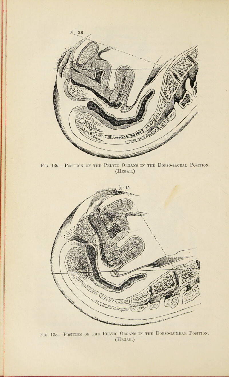 Fig. 1%.—Position of the Pelvic Oegans in the Dokso-saceal Position. (Hegak.) Fig. 13c. Position of the 1’elvic Oegans in the Dokso-lumbae I’osition. (Hegae.)