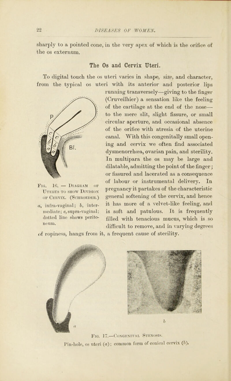sharply to a pointed cone, in the very apex of which is the orifice of the os externum. The Os and Cervix Uteri. To digital touch the os uteri varies in shape, size, and character, from the typical os uteri with its anterior and posterior lips running transversely—giving to the finger (Cruveilhier) a sensation like the feeling of the cartilage at the end of the nose— to the mere slit, slight fissure, or small circular aperture, and occasional absence of the orifice with atresia of the uterine canal. With this congenitally small open- ing and cervix we often find associated dysmenorrhoea, ovarian pain, and sterility. In multipara the os may be large and dilatable, admitting the point of the finger; or fissured and lacerated as a consequence of labour or instrumental delivery. In pregnancy it partakes of the characteristic general softening of the cervix, and hence it has more of a velvet-like feeling, and is soft and patulous. It is frequently filled with tenacious mucus, which is so difficult to remove, and in varying degrees of ropiness, hangs from it, a frequent cause of sterility. a OF Cervix. (Sciiroeder.) iiifra-vaginal; h, inter- mediate; c, supra-vaginal; dotted line shows perito- neum. Fig. 17.—Congenital Stenosis. Fin-liole, os uteri (a); common form of conical cervix (?>).