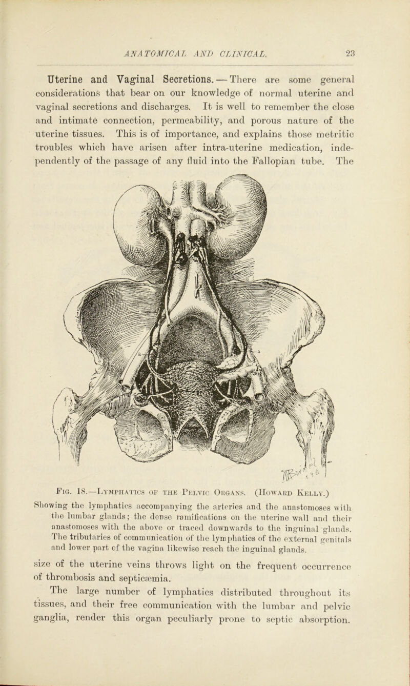 Uterine and Vaginal Secretions. — There are some general considerations that bear on our knowledge of normal uterine and vaginal secretions and discharges. It is well to remember the close and intimate connection, permeability, and porous nature of the uterine tissues. This is of importance, and explains those metritic troubles which have arisen after intra-uterine medication, inde- pendently of the passage of any fluid into the Fallopian tube. The Fig. 18.—Lymphatics of tiif ri:Lvrc Ougaxs. (IIowakd Kelly.) Sliowing the lymphatics accompanying the arteries and tlie anastomoses Miili tlie lumbar glands; the dense ramifications on the uterine wall and their anastomoses with the above or traced downwards to the inguinal glands. The tributaries of communication of tlie lymphatics of the external genitals and lower part of the vagina likewise reach the inguinal glands. size of the uterine veins throws liglit on the frequent occurrence' of thrombosis and septicaemia. The large number of lymphatics distributed throughout its tissues, and their free communication wdth the lumbar and pelvic ganglia, render this organ peculiarly prone to septic absolution.