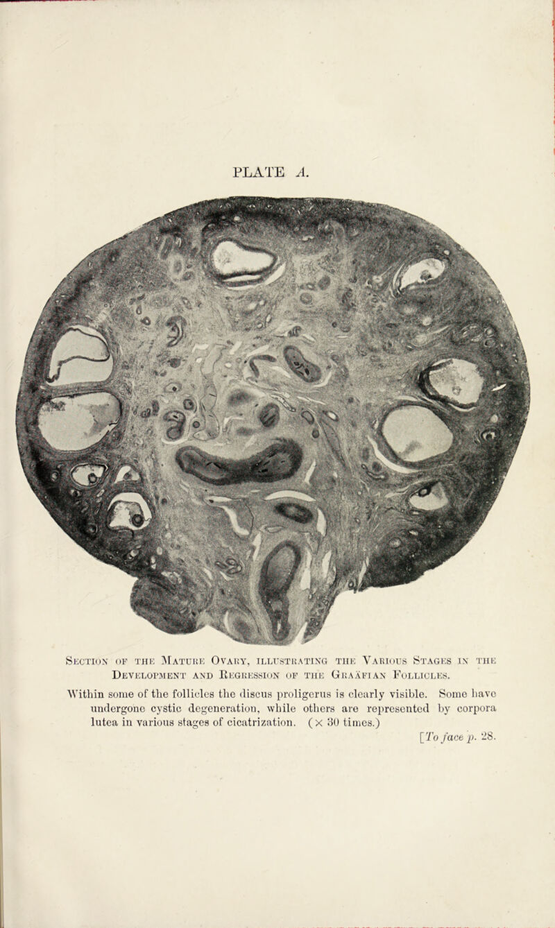 Section of the ]Matuke Ovaky, illfstkating the Various Stages in the Development and Regression of T]ie Graafian Follicles. Within some of the follicles the discus proligerus is clearly visible. Some liave undergone cystic degeneration, while others are represented by corpora lutea in various stages of cicatrization, (x 8U times.)