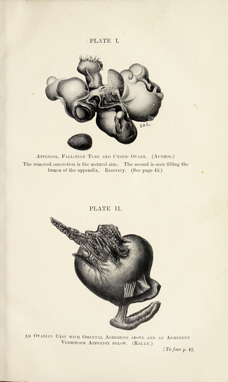 PLATP] T. Appendix, Fallopian Tube and Cystic Ovaky. (Autiioi;.) The removed concretion is the Dutnrnl size. The second is seen tilling the lumen of the appendix. Kecovery. (See page 43.) PLxVTE TI. An Ovarian Cyst with Omental Adhesions above and an Adherent Vermipoiim Appendix below. (Kelly.)