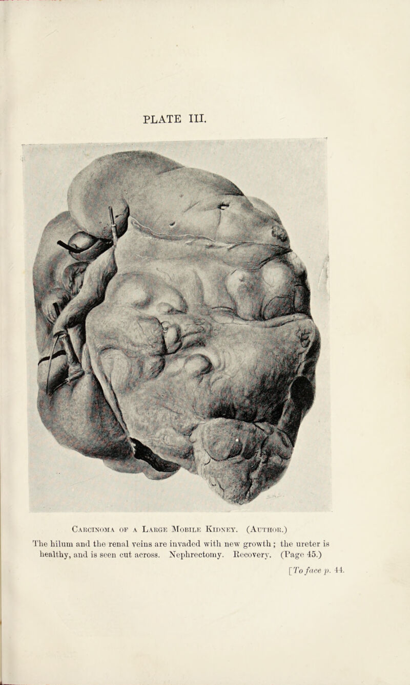 Carcinoma of a Large IMobile Kidney. (Author.) The hilum and the renal veins are invaded with new growth ; the ureter is healthy, and is seen cut across. Nephrectomy. Eecoverv. (T’age 45.)