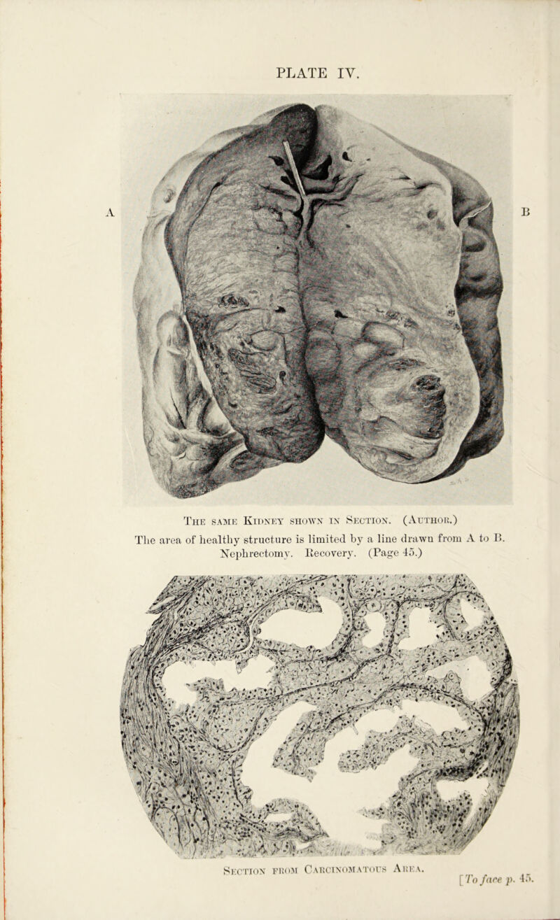 The SA5IE Kidxey shown in Section. (Author.) The area of healthy structure is limited by a line drawn from A to B. Nephrectomy. Itecovery. (Page 45.) Section from Carcino^matous
