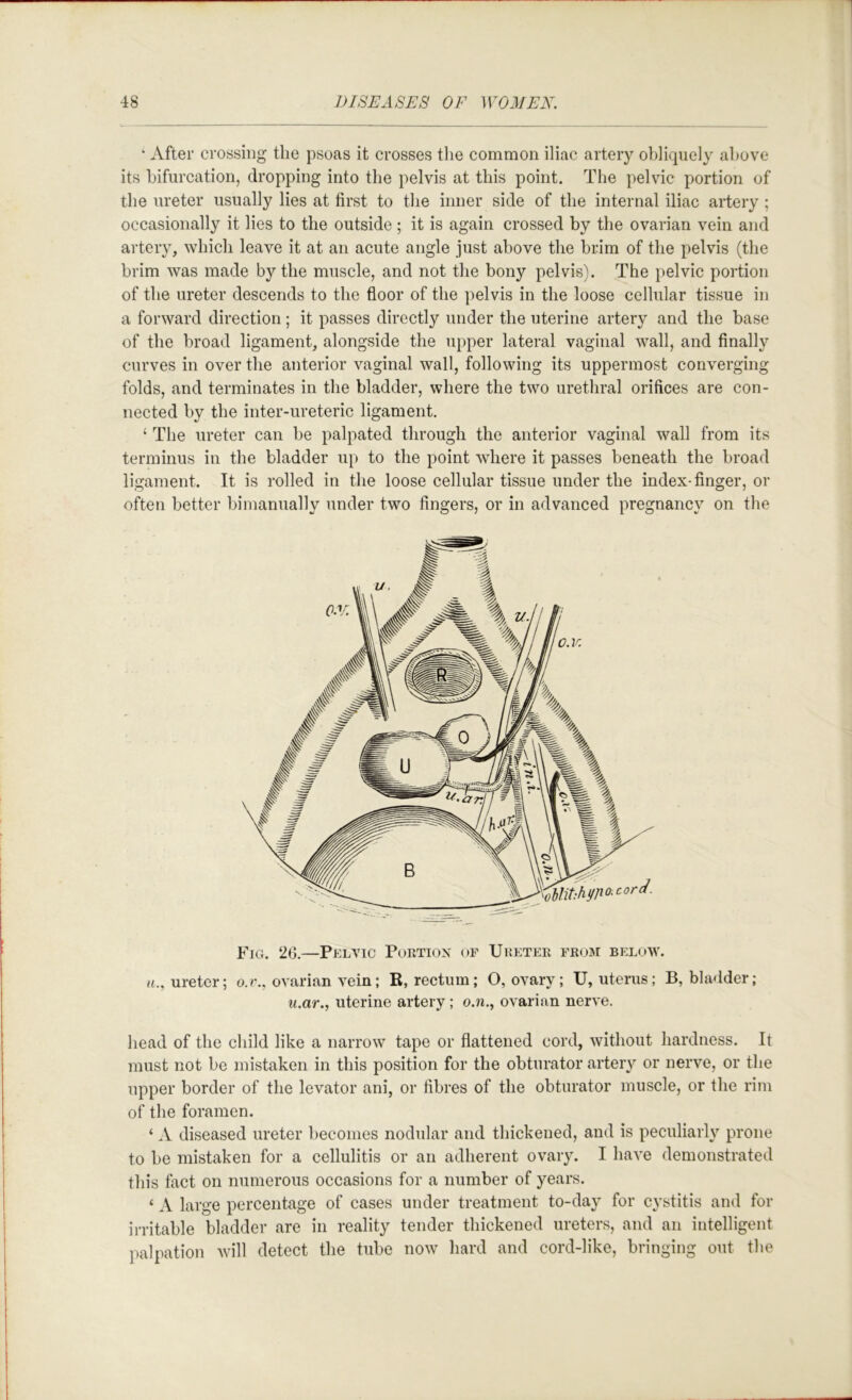 ‘ After crossing the psoas it crosses the common iliac artery obliquely above its bifurcation, dropping into the pelvis at this point. The pelvic portion of the ureter usually lies at first to the inner side of the internal iliac artery; occasionally it lies to the outside ; it is again crossed by the ovarian vein and artery, which leave it at an acute angle just above the brim of the pelvis (the brim was made by the muscle, and not the bony pelvis). The pelvic portion of the ureter descends to the floor of the pelvis in the loose cellular tissue in a forward direction; it passes directly under the uterine artery and the base of the broad ligament, alongside the upper lateral vaginal wall, and finally curves in over the anterior vaginal wall, following its uppermost converging folds, and terminates in the bladder, where the two urethral orifices are con- nected by the inter-ureteric ligament. ‘ The ureter can be palpated through the anterior vaginal wall from its terminus in the bladder up to the point where it passes beneath the broad ligament. It is rolled in the loose cellular tissue under the index-finger, or often better bimanually under two fingers, or in advanced pregnancy on the Fig. 20.—Pelvic Portion of Ureter froim below. ureter; o.r., ovarian vein; R, rectum; O, ovary; U, uterus; B, bladder; u.ar., uterine artery; o.r., ovarian nerve. head of the child like a narrow tape or flattened cord, without hardness. It must not be mistaken in this position for the obturator artery or nerve, or the upper border of the levator ani, or fibres of the obturator muscle, or the rim of the foramen. ‘ A diseased ureter becomes nodular and thickened, and is peculiarly prone to be mistaken for a cellulitis or an adherent ovary. I have demonstrated this fact on numerous occasions for a number of years. ‘ A large percentage of cases under treatment to-day for cystitis and for irritable bladder are in reality tender thickened ureters, and an intelligent jialpation will detect the tube now hard and cord-like, bringing out the