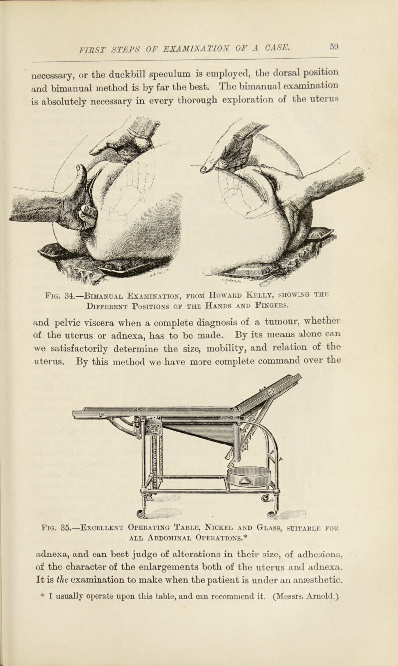 necessary, or the duckbill speculum is employed, the dorsal position and bimanual method is by far the best. The bimanual examination is absolutely necessary in every thorough exploration of the uterus Fig. 35.—Excellent Opekating Table, Nickel and Glass, suitable fob ALL Abdominal Opebations.* adnexa, and can best judge of alterations in their size, of adhesions, of the character of the enlargements both of the uterus and adnexa. It is the examination to make when the patient is under an anaesthetic. * I usually operate upon this table, and can recommend it. (INIessrs. Arnold.) Fig. 34.—Bimanual Examination, fpvOM Howabd Kelly, showing the Different Positions of the Hands and Fingers. and pelvic viscera when a complete diagnosis of a tumour, whether of the uterus or adnexa, has to be made. By its means alone can we satisfactorily determine the size, mobility, and relation of the uterus. By this method we have more complete command over the