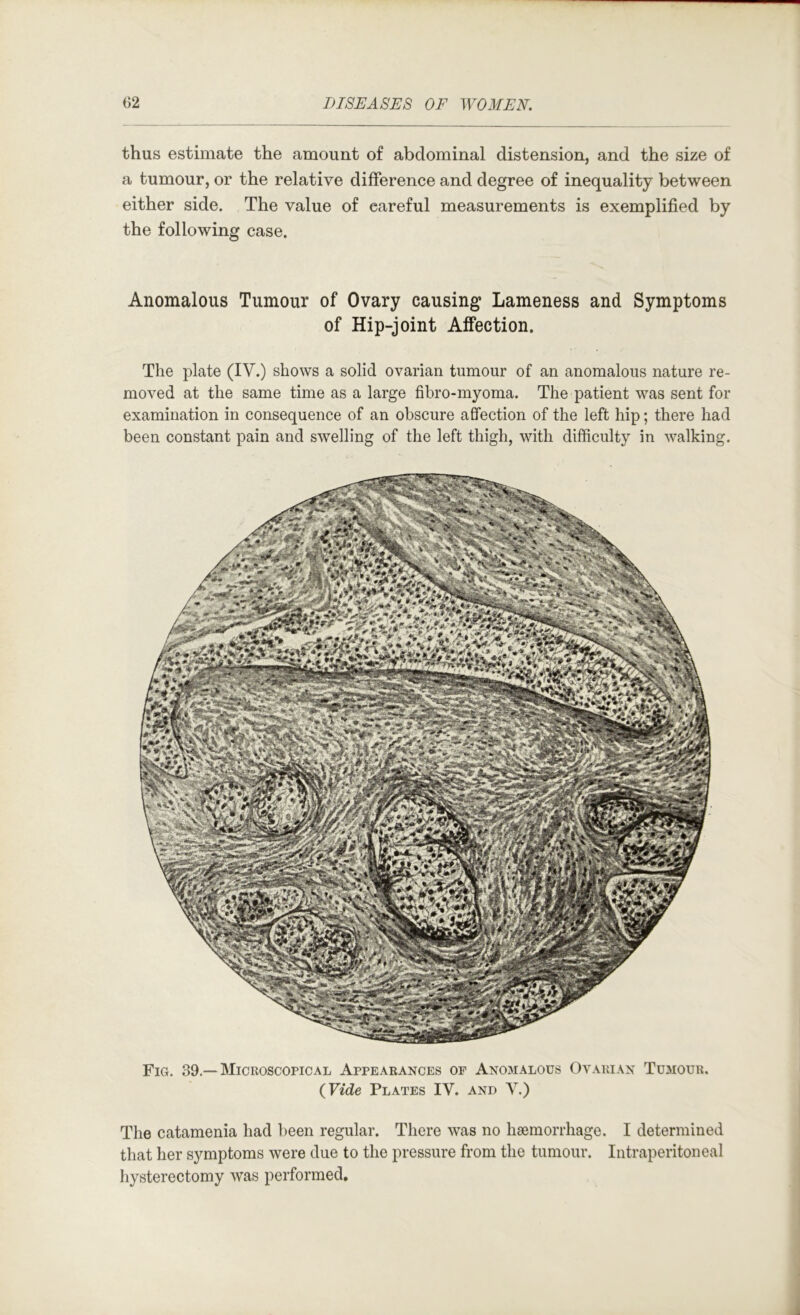 thus estimate the amount of abdominal distension, and the size of a tumour, or the relative difference and degree of inequality between either side. The value of careful measurements is exemplified by the following case. Anomalous Tumour of Ovary causing Lameness and Symptoms of Hip-joint Affection. The plate (IV.) shows a solid ovarian tumour of an anomalous nature re- moved at the same time as a large fibro-myoma. The patient was sent for examination in consequence of an obscure affection of the left hip; there had been constant pain and swelling of the left thigh, with difficulty in walking. Fig. 39.—Microscopical Appearances of Anomalous Ovarian Tumour. (Jlide Plates IV. and V.) The catamenia had been regular. There was no haemorrhage. I determined that her symptoms were due to the pressure from the tumour. Intraperitoneal hysterectomy was performed.