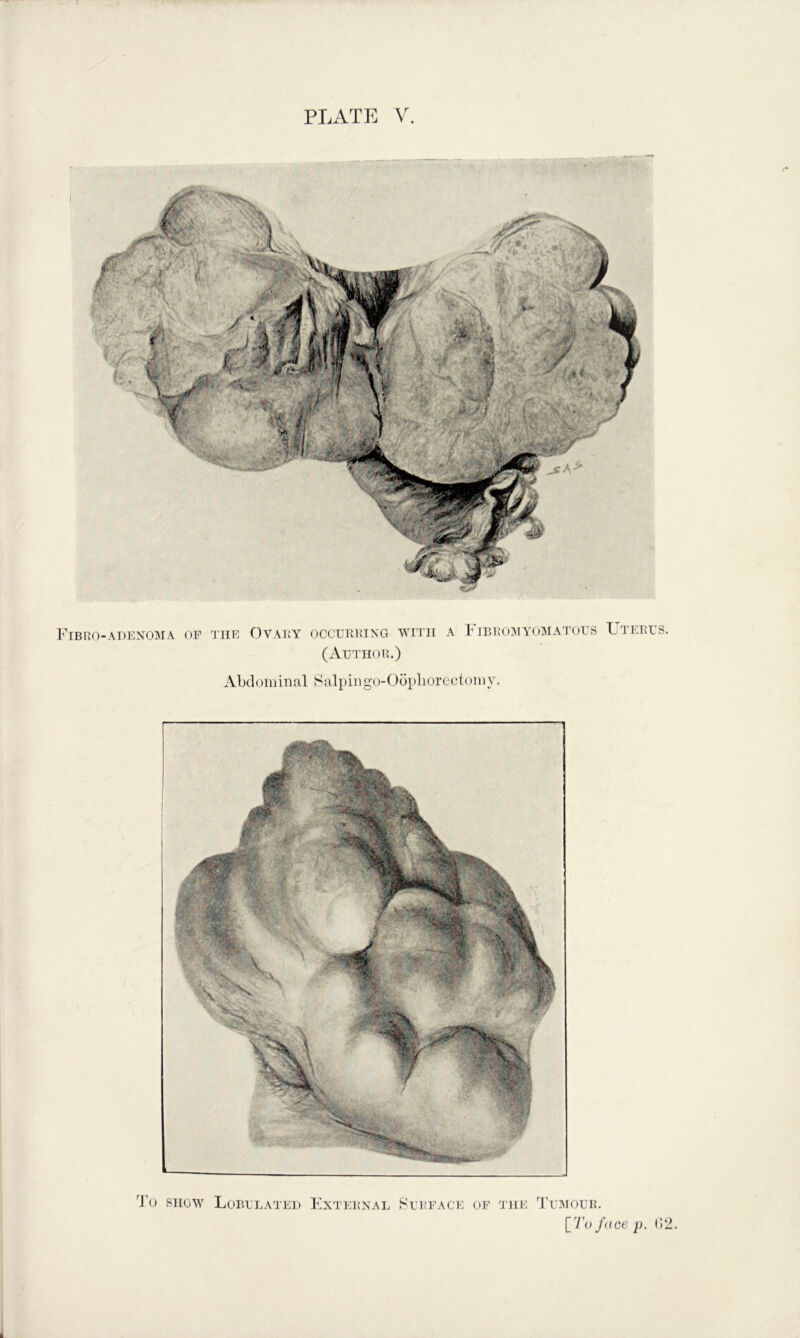 Fibko-adenoma op the OVAKY OCCElllHNG WITH A FjB1!0:\1 YOMATOES UtEEES. (Author.) Abdominal Salpingo-Oo})liorcctomy. d’O SHOW Loeelatei) External Rerface of the Tebiour. [V’o face p. (12.