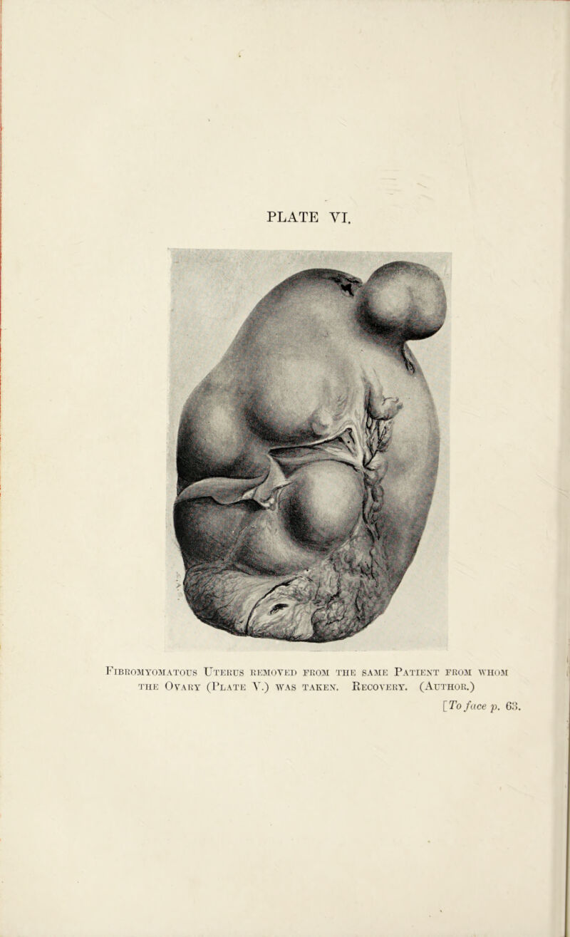 PLATE YT Fibkomyomatous Uterus removed THE (3vary (1*late X.) was FROM THE SAME PaTIEXT FR03I WH03I TAKEX. Recovery. (Author.)