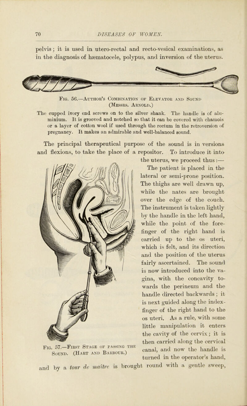 pelvis; it is used in utero-rectal and recto-vesical examinations, as in the diagnosis of hsematocele, polypus, and inversion of the uterus. Fig. 56.—Author’s Combination of Elevator and Sound (Messrs. Arnold.) The cupped ivory end screws on to the silver shank. The handle is of alu- minium. It is grooved and notched so that it can be covered with chamois or a layer of cotton wool if used through the rectum in the retroversion of pregnancy. It makes an admirable and well-balanced sound. The principal therapeutical purpose of the sound is in versions and flexions, to take the place of a repositor. To introduce it into the uterus, we proceed thus :— The patient is placed in the lateral or semi-prone position. The thighs are well drawn up, while the nates are brought over the edge of the couch. The instrument is taken lightly by the handle in the left hand, while the point of the fore- finger of the right hand is carried up to the os uteri, which is felt, and its direction and the position of the uterus fairly ascertained. The sound is now introduced into the va- gina, with the concavity to- \vards the perineum and the handle directed backwards ; it is next guided along the index- finger of the right hand to the os uteri. As a rule, with some little manipulation it enters the cavity of the cervix; it is then carried along the cervical canal, and now the handle is turned in the operator’s hand, and by a tour de maUre is brought round with a gentle sweep. Fig. 57.—First Stage of passing the Sound. (Hart and Barbour.)