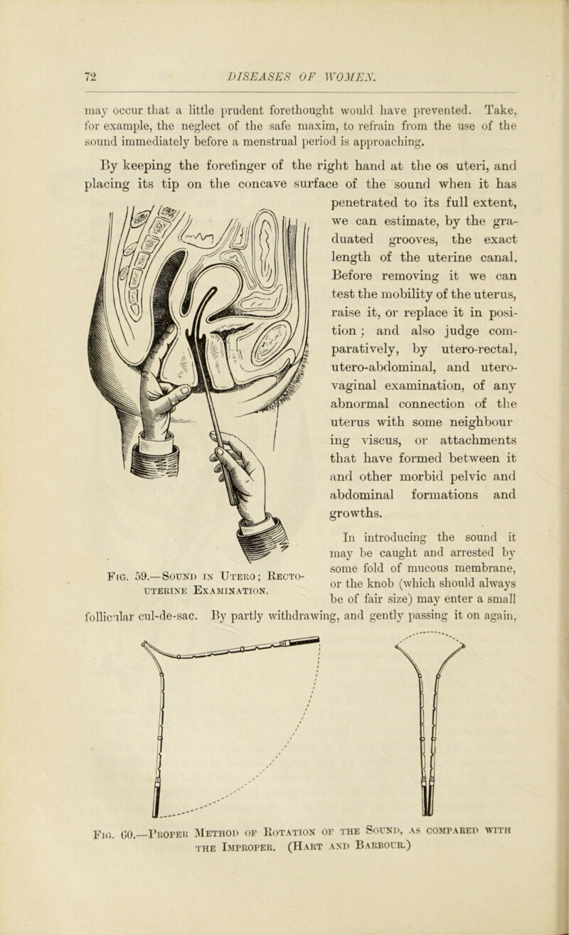 may occur that a little prudent forethought would have prevented. Take, for example, the neglect of the safe maxim, to refrain from the use of the sound immediately before a menstrual period is approaching. By keeping the forefinger of the right hand at the os uteri, and placing its tip on the concave surface of the sound when it has penetrated to its full extent, we can estimate, by the gra- duated grooves. the exact length of the uterine canal. Before removing it we can test the mobility of the uterus, raise it, or replace it in posi- tion ; and also judge com- paratively, by utero-rectal, utero-abdominal, and utero- vaginal examination, of any abnormal connection of the uterus with some neighbour mg viscus, or attachments that have formed between it and other morbid pelvic and abdominal formations and growths. In introducing the sound it may be caught and arrested by some fold of mucous membrane, or the knob (which should always be of fair size) may enter a small follicular cul-de-sac. By partly withdrawing, and gently passing it on again. Fig, 59.— Sound in Uteuo; Recto- uterine Examination. Fig. 00. Bkoper Method of Rotation of the Sound, as compared with THE Improper. (Hart and Barbour.)