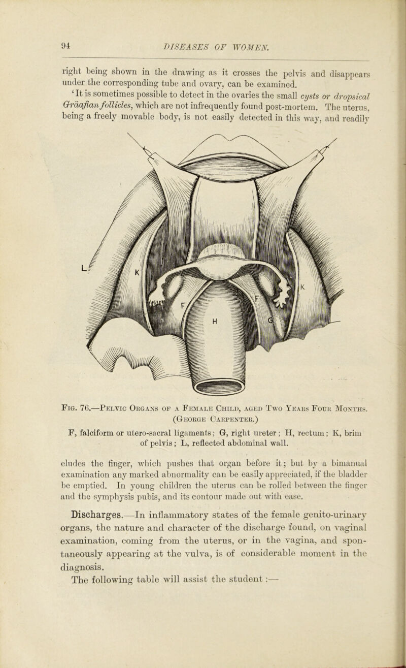 right being shown in the drawing as it crosses the pelvis and disappears under the corresponding tube and ovary, can be examined. ‘It is sometimes possible to detect in the ovaries the small cysts or dropsical Or'dafianfollicles, which are not infrequently found post-mortem. The uterus, being a freely movable body, is not easily detected in this way, and readil}' Fig. 76.—Pelvic Okgaks of a Female Child, aged Two Yeaes Four IMonths. (George Carpenter.) F, falciform or utero-sacral ligaments; G, right ureter ; H, rectum; K, brim of pelvis; L, reflected abdominal wall. eludes the finger, which pushes that organ before it; but by a bimanual examination any marked abnormality can be easily appreciated, if the bladder be emptied. In young children the uterus can be rolled between the finger and the symphysis pubis, and its contour made out with ease. Discharges.—In inflammatory states of the female genito-urinary organs, the nature and character of the discharge found, on vaginal examination, coming from the uterus, or in the vagina, and spon- taneously appearing at the vulva, is of considerable moment in the diagnosis. The following table will assist the student:—