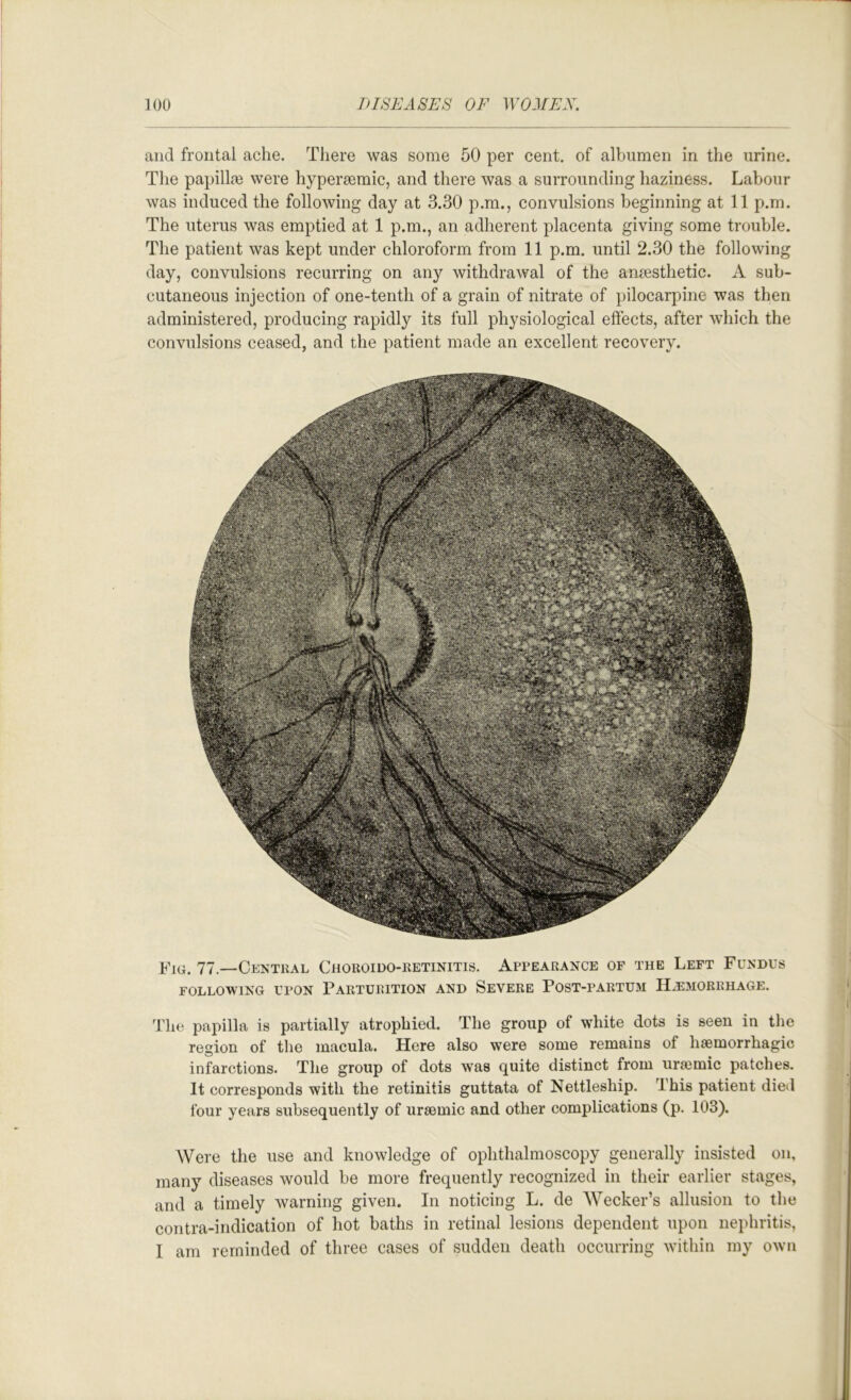 and frontal ache. There was some 50 per cent, of albumen in the urine. The papillm were hypersemic, and there was a surrounding haziness. Labour was induced the following day at 3.30 p.m., convulsions beginning at 11 p.m. The uterus was emptied at 1 p.m., an adherent placenta giving some trouble. The patient was kept under chloroform from 11 p.m. until 2.30 the following day, convulsions recurring on any withdrawal of the anaesthetic. A sub- cutaneous injection of one-tenth of a grain of nitrate of pilocarpine was then administered, producing rapidly its full physiological effects, after which the convulsions ceased, and the patient made an excellent recovery. 77.—Central Choroido-eetinitis. Appearance of the Left Fundus FOLLOWING UPON PARTURITION AND SEVERE POST-PARTUM H^E3I0RRHAGE. Tht, papilla is partially atrophied. The group of white dots is seen in the region of the macula. Here also were some remains of haemorrhagic infarctions. The group of dots was quite distinct from uraemic patches. It corresponds with the retinitis guttata of Nettleship. This patient died four years subsequently of uraemic and other complications (p. 103). Were the use and knowledge of ophthalmoscopy generally insisted on, many diseases would be more frequently recognized in their earlier stages, and a timely warning given. In noticing L. de Wecker’s allusion to the contra-indication of hot baths in retinal lesions dependent upon nephritis, I am reminded of three cases of sudden death occurring within my ow’ii