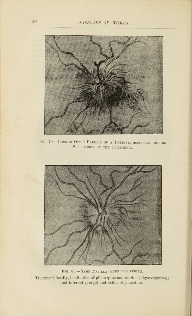 Fig. 79.—Choked Optic Papilla op a Patient, occurring during Suppression op the Catamenia. Fig. 80.—Same Papilla avhen recovering. Treatment locally, instillation of pilocarpine and eserine (physostigmine) and internally, ergot and iodide of potassium.