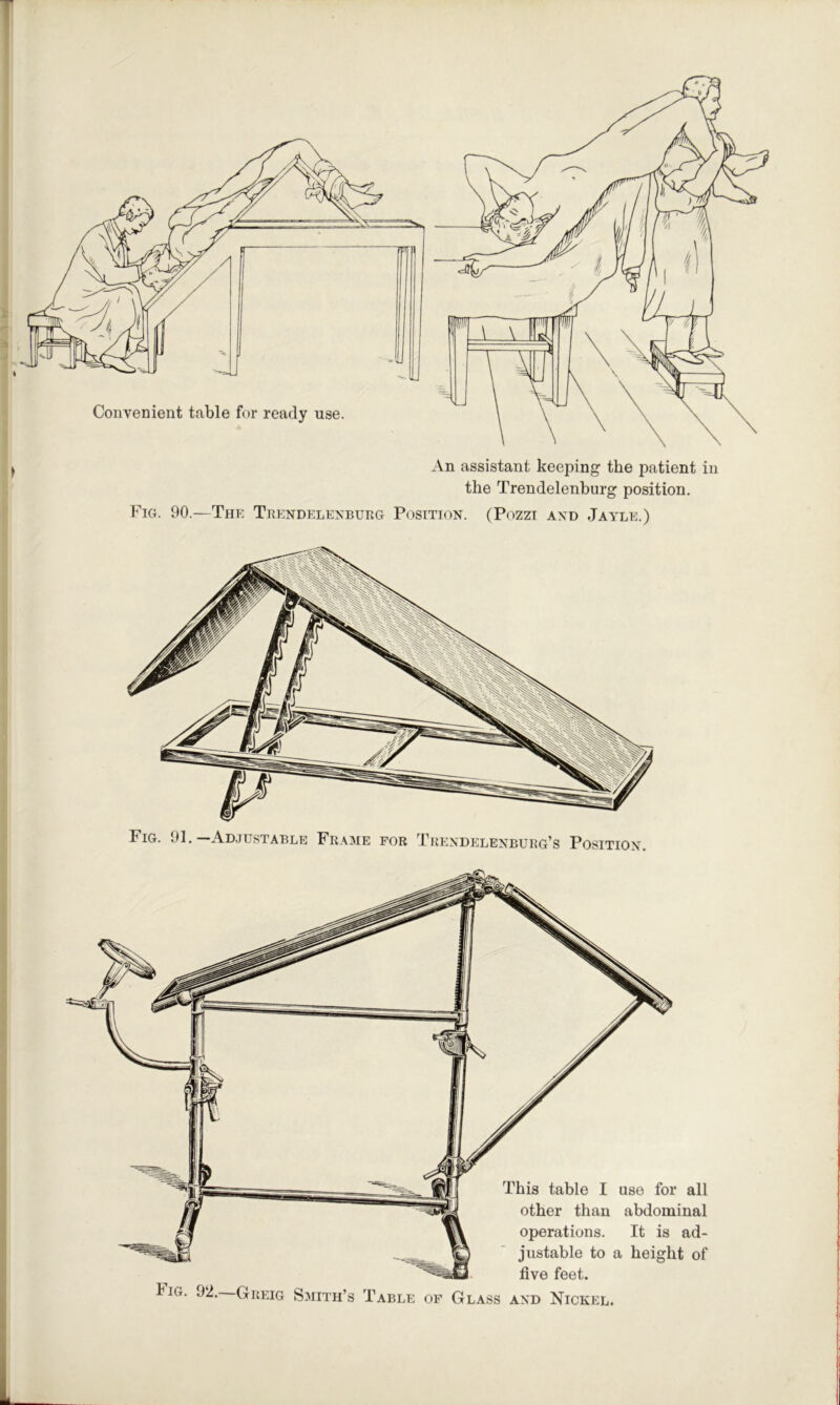 the Trendelenburg position. Fig. 90.—The Tkendelexburg Position. (Pozzi and Jayle.) Fig. 91.—Adjustable Fra3ie for Ti{e\delenburg’s Position. This table I use for all other than abdominal operations. It is ad- justable to a height of five feet. IiG. 92.—Greig Smith’s Table of Glass and Nickel.