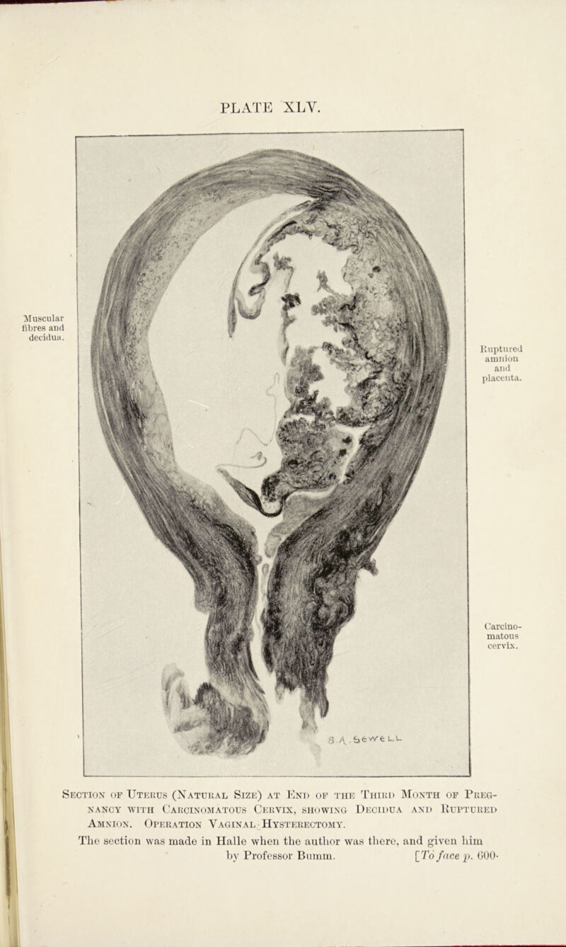 PLATE XLV. ]\Iusculav fibres and decidua. Kuptured amnion and placenta. Carcino- matous cervix. Section of Uterus (Natural Size) at End op the Third IMonth of Preg- nancy WITH Carcinomatous Cervix, showing Decidua and Kuptured Amnion. Operation Vaginal Hysterectomy. The section was made in Halle when the author was there, and given him by Professor Bumm. [To face p. (JOO-