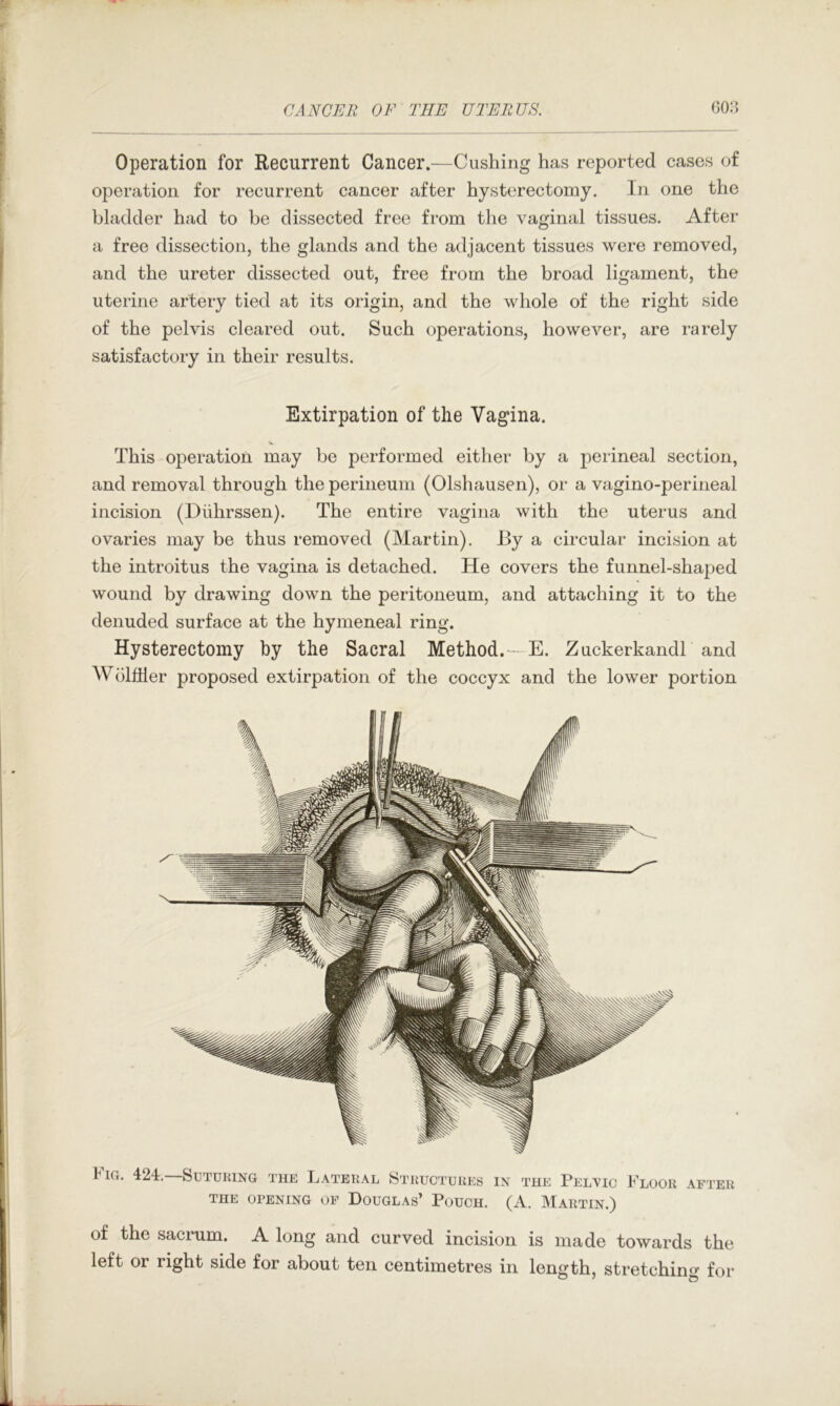 Operation for Recurrent Cancer.—Cushing has reported cases of operation for recurrent cancer after hysterectomy. In one the bladder had to be dissected free from the vaginal tissues. After a free dissection, the glands and the adjacent tissues were removed, and the ureter dissected out, free from the broad ligament, the uterine artery tied at its origin, and the whole of the right side of the pelvis cleared out. Such operations, however, are rarely satisfactory in their results. Extirpation of the Vagina. This operation may be performed either by a perineal section, and removal through the perineum (Olshausen), or a vagino-perineal incision (Diihrssen). The entire vagina with the uterus and ovaries may be thus removed (Martin). By a circular incision at the introitus the vagina is detached. He covers the funnel-shaped wound by drawing down the peritoneum, and attaching it to the denuded surface at the hymeneal ring. Hysterectomy by the Sacral Method.—E. Zuckerkandl and Wblfiler proposed extirpation of the coccyx and the lower portion tiG. 424. Suturing the Lateral Structures in the Pelvic Floor after THE opening of Douglas’ Pouch. (A. Martin.) of the sacrum. A long and curved incision is made towards the left or right side for about ten centimetres in lenfifth, stretchin^^ for