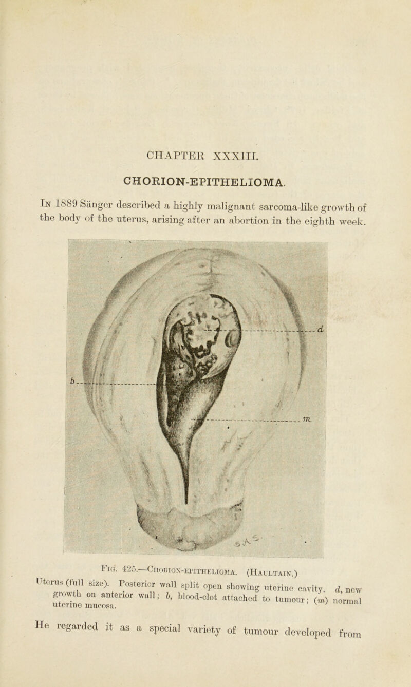 CHAPTER XXXIIT. CHORION-EPITHELIOMA. I n 1889 Siinger described a highly malignant sarcoma-like growth of the body of the uterus, arising after an abortion in the eighth week. r IG. T^.). -UHOEION-EPITHELIOMA. Uterus (fab size) Posterior wall split open showing uterine cavity, d, new growth on anterior wall; b, hlood-clot attached to tumour; (m) normal uterine mucosa. v } He regarded it as a special variety of tumour developed from