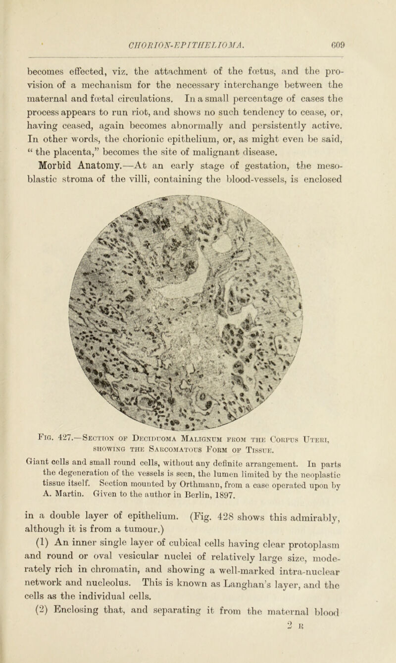 CIIORION’EP TTHEL TOMA. G09 becomes effected, viz. the attachment of the foetus, and the pro- vision of a mechanism for the necessary interchange between the maternal and foetal circulations. In a small percentage of cases the process appears to run riot, and shows no such tendency to cease, or, having ceased, again becomes abnormally and persistently active. In other words, the chorionic epithelium, or, as might even be said, “ the placenta,” becomes the site of malignant disease. Morbid Anatomy.—At an early stage of gestation, the meso- blastic stroma of the villi, containing the blood-vessels, is enclosed Fig. 427.—Section of Deciduoma Malignum from the Corpus Uteri, showing the Sarcomatous Form of Tissue. Giant cells and small round cells, without any definite arrangement. In parts the degeneration of the vessels is seen, the lumen limited by the neoplastic tissue itself. Section mounted by Orthmann, from a case operated upon by A. Martin. Given to the author in Berlin, 1897. in a double layer of epithelium. (Fig. 428 shows this admirably, although it is from a tumour.) (1) An inner single layer of cubical cells having clear protoplasm and round or oval vesicular nuclei of relatively large size, mode- rately rich in chromatin, and showing a well-marked intra-nuclear network and nucleolus. This is known as Langhan’s layer, and the cells as the individual cells. (2) Enclosing that, and separating it from the maternal blood