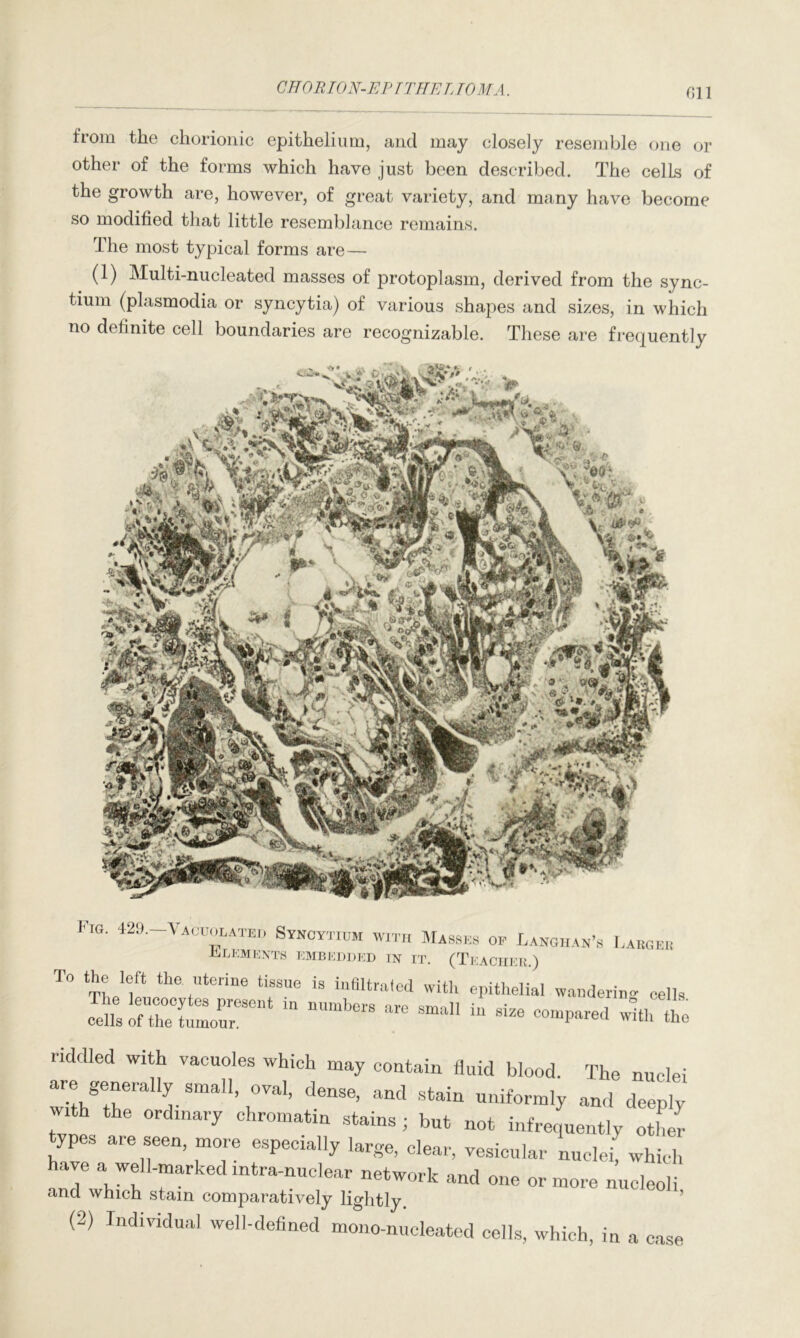 CHORION-EPI THE L TO MA. Gil from the chorionic epithelium, and may closely resemble one or other of the forms which have just been described. The cells of the growth are, however, of great variety, and many have become so modified that little resemblance remains. The most typical forms are— (1) Multi-nucleated masses of protoplasm, derived from the sync- tium (plasmodia or syncytia) of various shapes and sizes, in which no definite cell boundaries are recognizable. These are frequently Fig. 429—Vacuolated Syncytium with Masses of Langhan’s Largek ELEMENTS EMBEDDED IN IT. (TEACHER.) To the left the uterine tissue is infiltrated with epithelial wandering cells The leucocytes present in numbers nro m \ ° eils‘ cells of the tumour. S“a11 “ 8126 <=°>“P»ed with the riddled with vacuoles which may contain fluid blood. The nuclei ^hTt'rmaU> ral’ denSe’ and Stain Uniformly ^d deeply , h the 0rdmar^ chromatin stains j but not infrequently other types are seen, more especially large, clear, vesicular nuclei, which have a well-marked mtra-nuclear network and one or more nucleoli and which stain comparatively lightly (2) Individual well-defined mono-nucleated cells, which, in a case