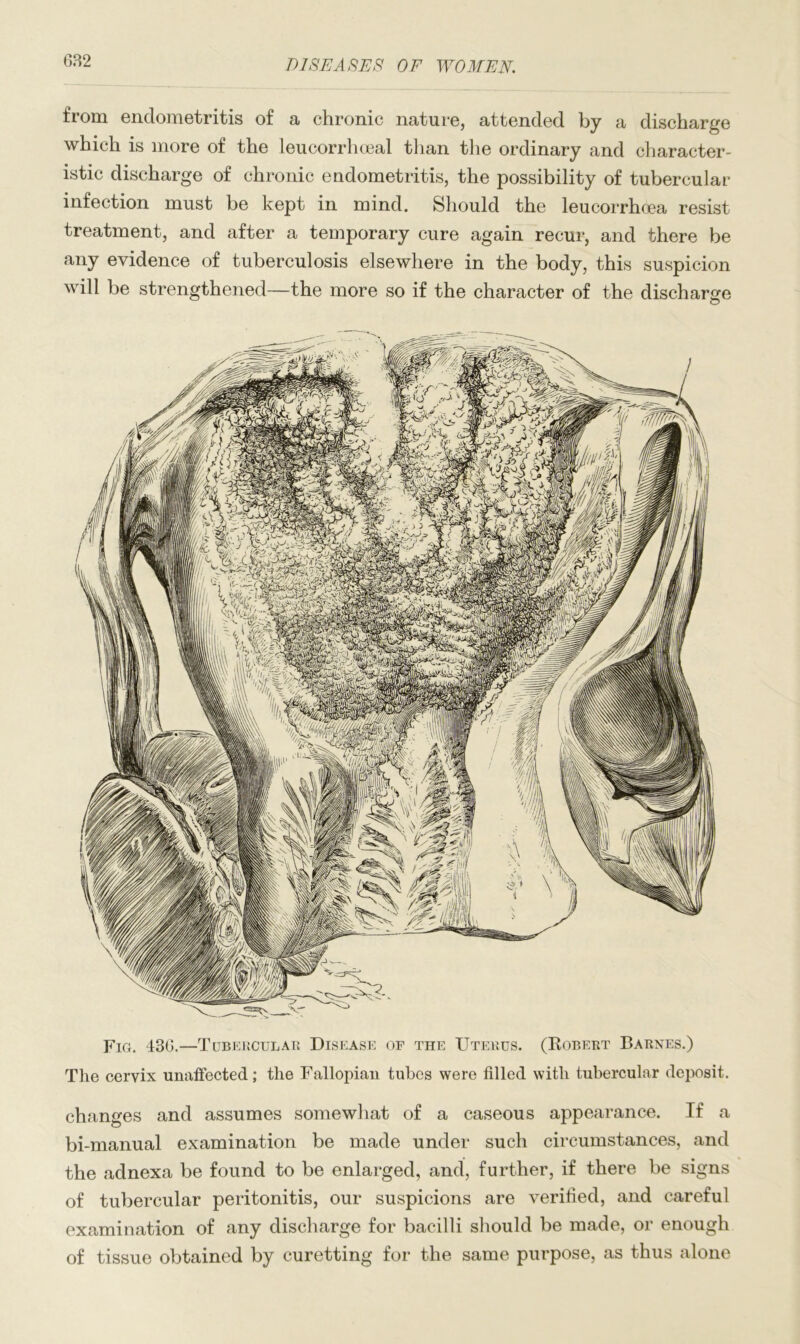 from endometritis of a chronic nature, attended by a discharge which is more of the leucorrhceal than the ordinary and character- istic discharge of chronic endometritis, the possibility of tubercular infection must be kept in mind. Should the leucorrhoea resist treatment, and after a temporary cure again recur, and there be any evidence of tuberculosis elsewhere in the body, this suspicion will be strengthened—the more so if the character of the discharge Fig. 436.—Tubercular Disease of the Uterus. (Kobert Barnes.) The cervix unaffected; the Fallopian tubes were filled with tubercular deposit. changes and assumes somewhat of a caseous appearance. If a bi-manual examination be made under such circumstances, and the adnexa be found to be enlarged, and, further, if there be signs of tubercular peritonitis, our suspicions are verified, and careful examination of any discharge for bacilli should be made, or enough of tissue obtained by curetting for the same purpose, as thus alone