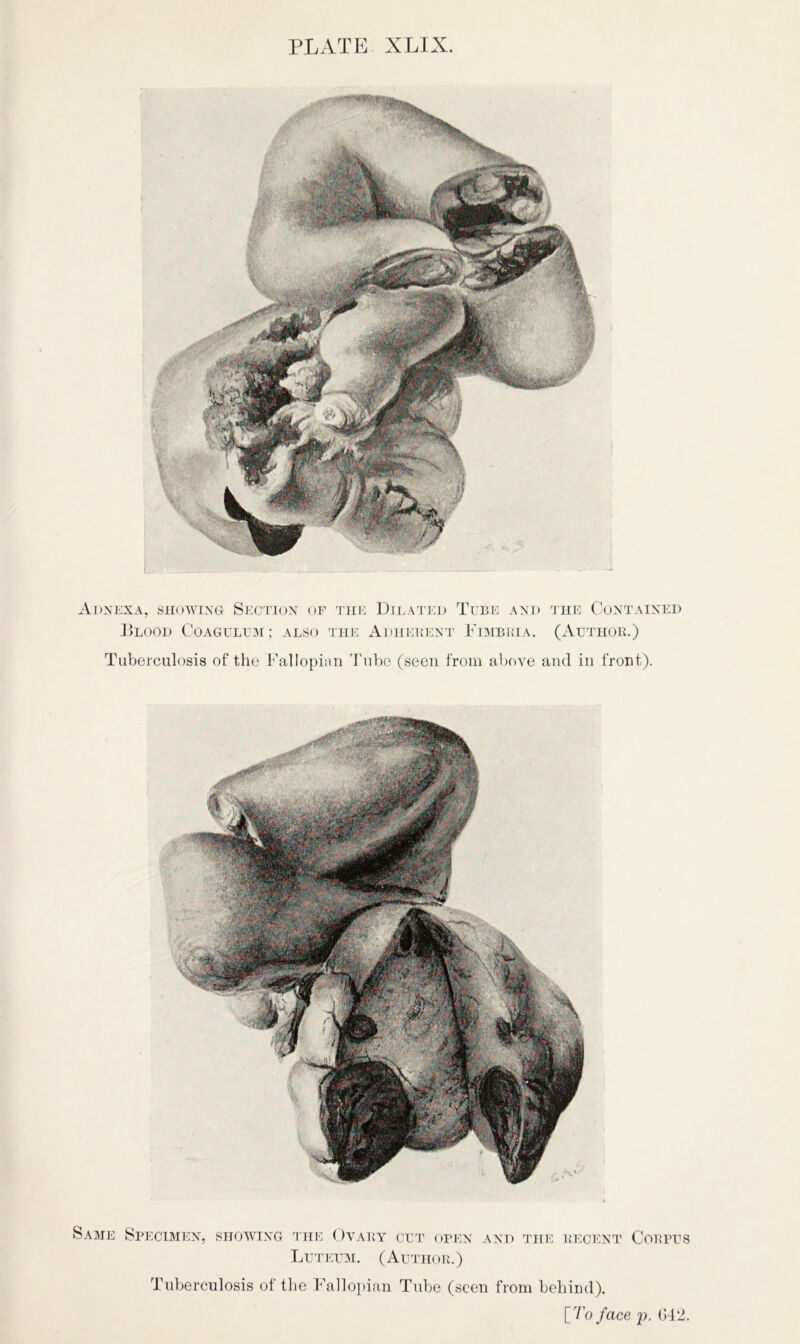 Adnexa, showing Section of the Dilated Tube and the Contained Blood Coagulum ; also the Adherent Fimbria. (Author.) Tuberculosis of the Fallopian Tube (seen from above and in front). Same Specimen, showing the Ovary cut open and the recent Corpus Luteum. (Author.) Tuberculosis of the Fallopian Tube (seen from behind). [To face p, 642.