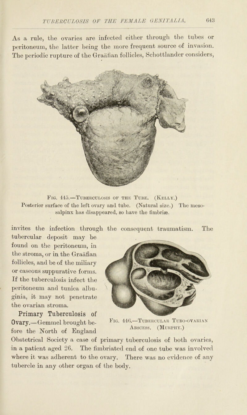 As a rule, the ovaries are infected either through the tubes or peritoneum, the latter being the more frequent source of invasion. The periodic rupture of the Graafian follicles, Schottlander considers, Fig. 445.—Tuberculosis of the Tube. (Kelly.) Posterior surface of the left ovary and tube. (Natural size.) The meso- salpinx has disappeared, so have the fimbriae. invites the infection through the consequent traumatism, tubercular deposit may be found on the peritoneum, in the stroma, or in the Graafian follicles, and be of the miliary or caseous suppurative forms. If the tuberculosis infect the peritoneum and tunica albu- ginia, it may not penetrate the ovarian stroma. Primary Tuberculosis of Ovary.—Gemmel brought be- The England Fig. 446.—Tubercular Tubo-ovarian Abscess. (Murphy.) fore the North of Obstetrical Society a case of primary tuberculosis of both ovaries, in a patient aged 26. The fimbriated end of one tube was involved where it was adherent to the ovary. There was no evidence of any tubercle in any other organ of the body.