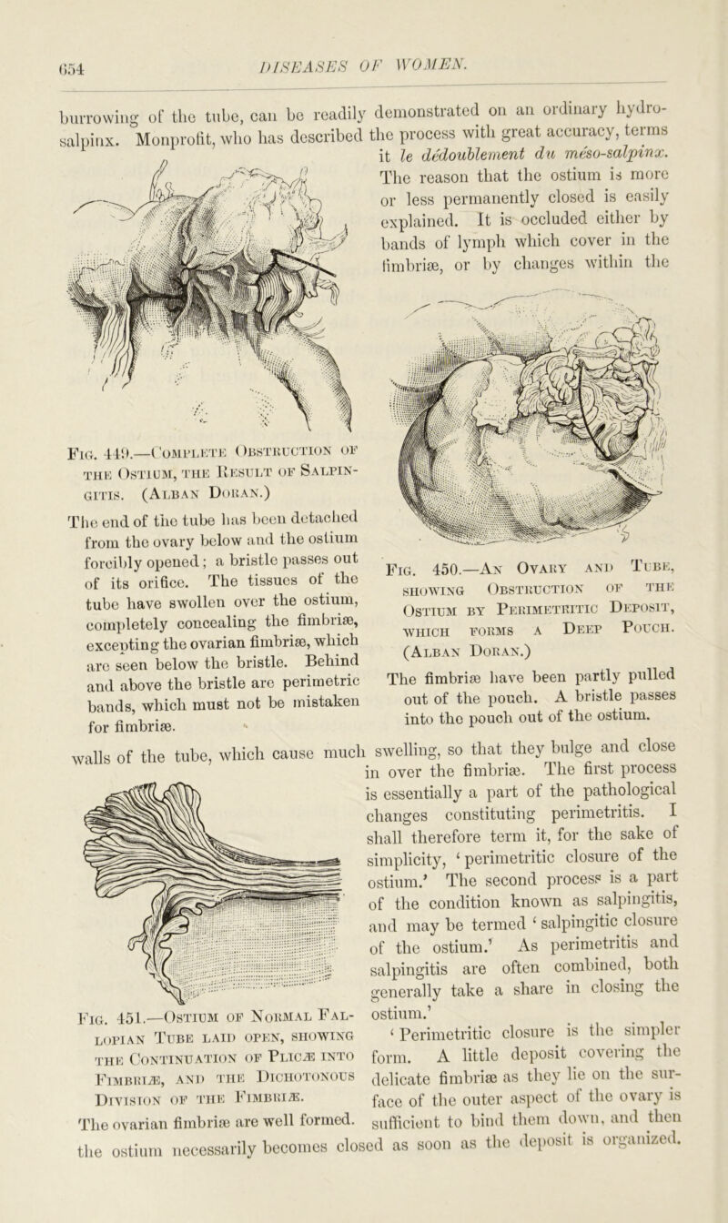 burrowing of the tube, can be readily demonstrated on an ordinary hydro- salpinx. Monprotit, who has described the process with great accuracy, terms it le dedoublement du meso-salpinx. The reason that the ostium is more or less permanently closed is easily explained. It is occluded either by bands of lymph which cover in the fimbriae, or by changes within the Fig. 449—Complete ( )bstruction of the Ostium, the Result of Salpin- gitis. (Alban Doran.) The end of the tube has been detached from the ovary below and the ostium forcibly opened; a bristle passes out of its orifice. The tissues of the tube have swollen over the ostium, completely concealing the fimbiise, excepting the ovarian fimbriae, which are seen below the bristle. Behind and above the bristle are perimetric bands, which must not be mistaken for fimbriae. Fig. 450—An Ovary and Tube, showing Obstruction of the Ostium by Perimetritic Deposit, which forms a Deep Pouch. (Alban Doran.) The fimbriae have been partly pulled out of the pouch. A bristle passes into the pouch out of the ostium. walls of the tube, which cause much swelling, so that they bulge and close in over the fimbriae. The first process is essentially a part of the pathological changes constituting perimetritis. I shall therefore term it, for the sake of simplicity, ‘ perimetritic closure of the ostium.’ The second process is a part of the condition known as salpingitis, and may be termed ‘ salpingitic closure of the ostium.’ As perimetritis and salpingitis are often combined, both generally take a share in closing the Fig. 451.—Ostium of Normal Fal- ostium.’ lopian Tube laid open, showing ‘ Perimetritic closure is the simpler the Continuation of Plic^i into form. A little deposit covering the Fimbria, and the Dichotonous delicate fimbriae as they lie on the sur- Division of the Fimbri*. face 0f ffie outer aspect ot the ovary is The ovarian fimbriae are well formed, sufficient to bind them down, and then the ostium necessarily becomes closed as soon as the deposit is organized.