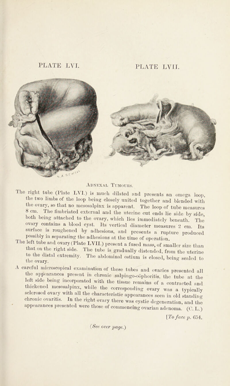 PLATE LVII. Adnexal Tumours. The right tube (Plate LVI.) is much dilated and presents an omega loop, the two limbs of the loop being closely united together and blended with the ovary, so that no mesosalpinx is apparent. The loop of tube measures 8 cm. The fimbriated external and the uterine cut ends lie side by side, both being attached to the ovary, which lies immediately beneath. The ovary contains a blood cyst. Its vertical diameter measures 2 cm Its surface is roughened by adhesions, and presents a rupture produced possibly m separating the adhesions at tire time of operation The left tube and ovary (Plate PYU.) present a fused mass, of smaller size than at on the right side. 4 he tube is gradually distended, from the uterine to the distal extremity. The abdominal ostium is closed, being sealed to the ovary. careful microscopical examination of these tubes and ovaries presented all the appearances present in chronic salpingo-oophoritis, the tube at the left side being incorporated with the tissue remains of a contracted and thickened mesosalpinx, while the corresponding ovary was a typically sclerosed ovary with all the characteristic appearances seen in old standing chronic ovaritis. In the right ovary there was cystic degeneration, and the appearances presented were those of commencing ovarian adenoma. (0. L.) [To face p. 654. A (See over page.)