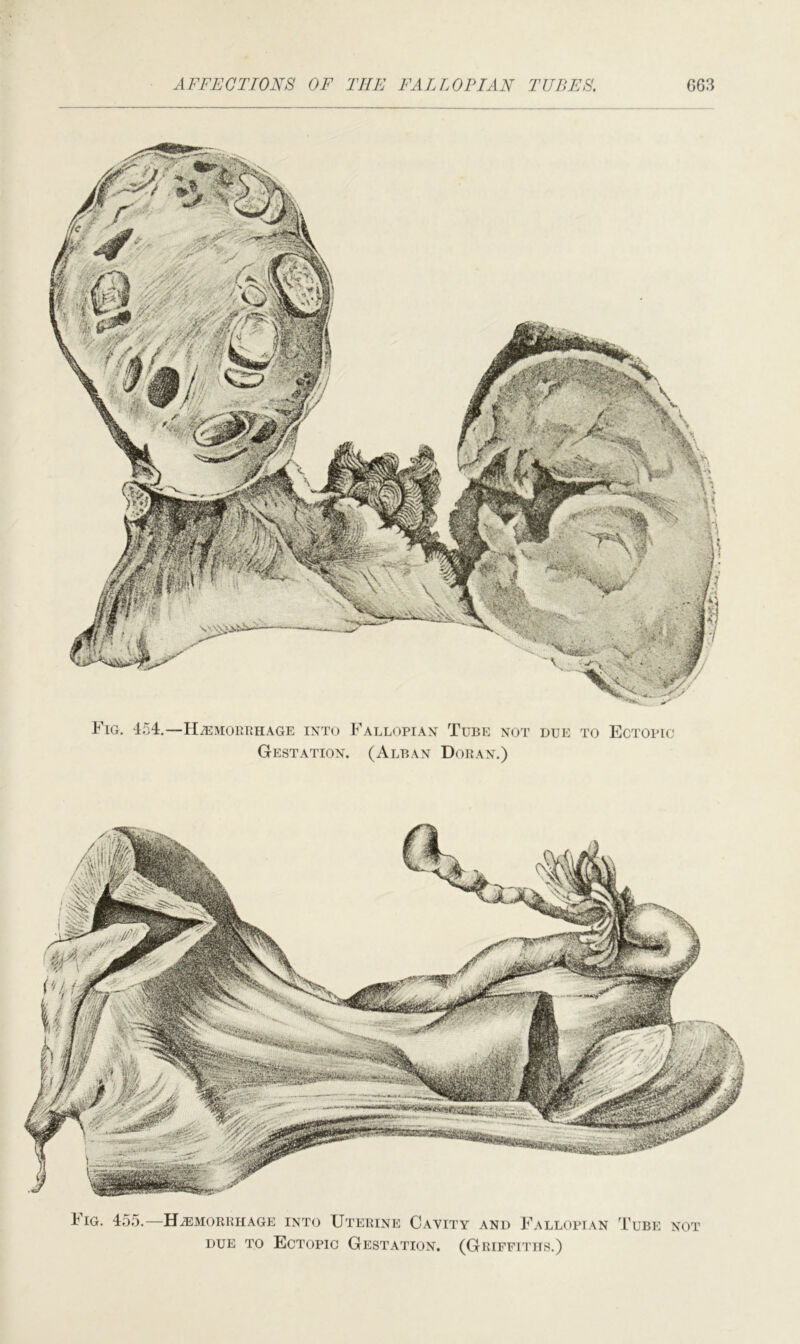 Fig. 454.—Hemorrhage into Fallopian Tube not due to Ectopic- Gestation. (Alban Doran.) Iig. 455.—Haemorrhage into Uterine Cayity and Fallopian Tube not due to Ectopic Gestation. (Griffiths.)