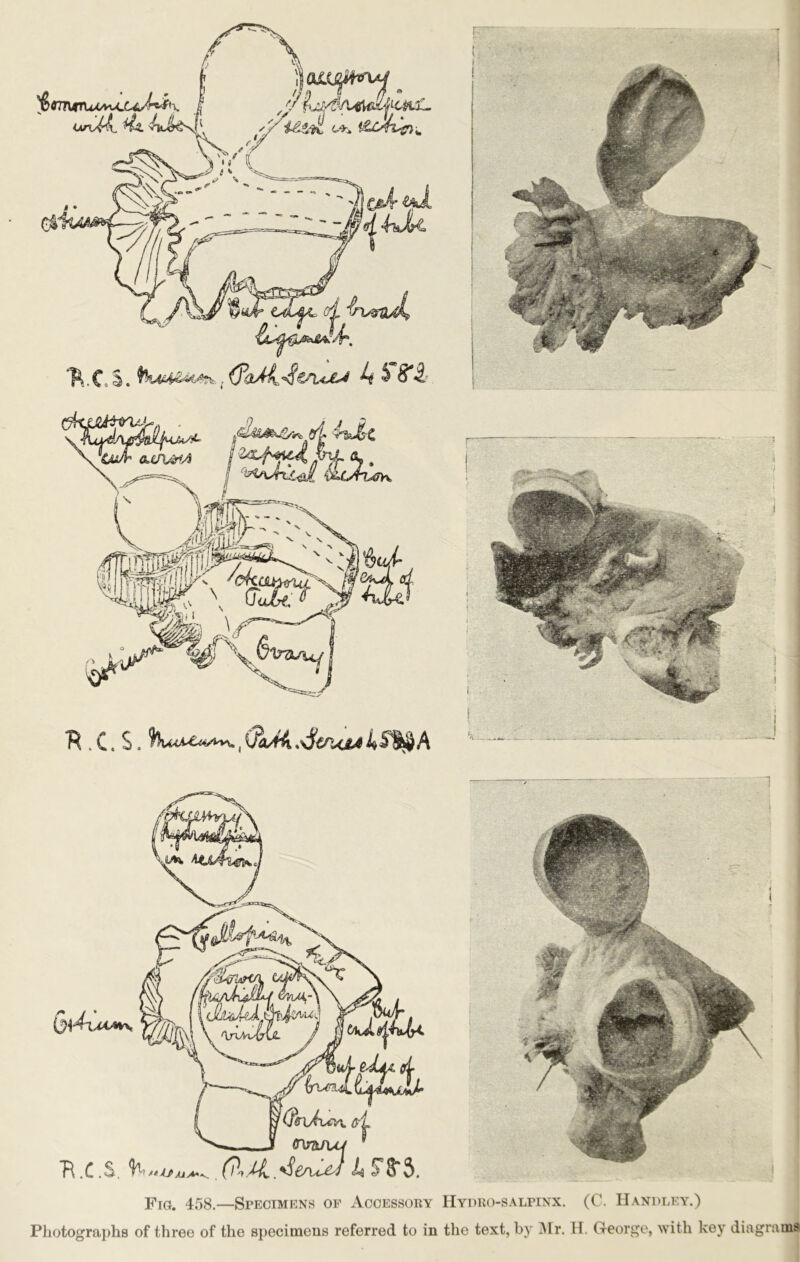 K. C* S. A' ^8*0.' *R. C. S. , QoJrk s$€/uja 4<fS^A Fig. 458.—Specimens of Accessory Hydro-salpinx. (C. Handley.) Photographs of three of the specimens referred to in the text, by Air. H. George, with key diagrams