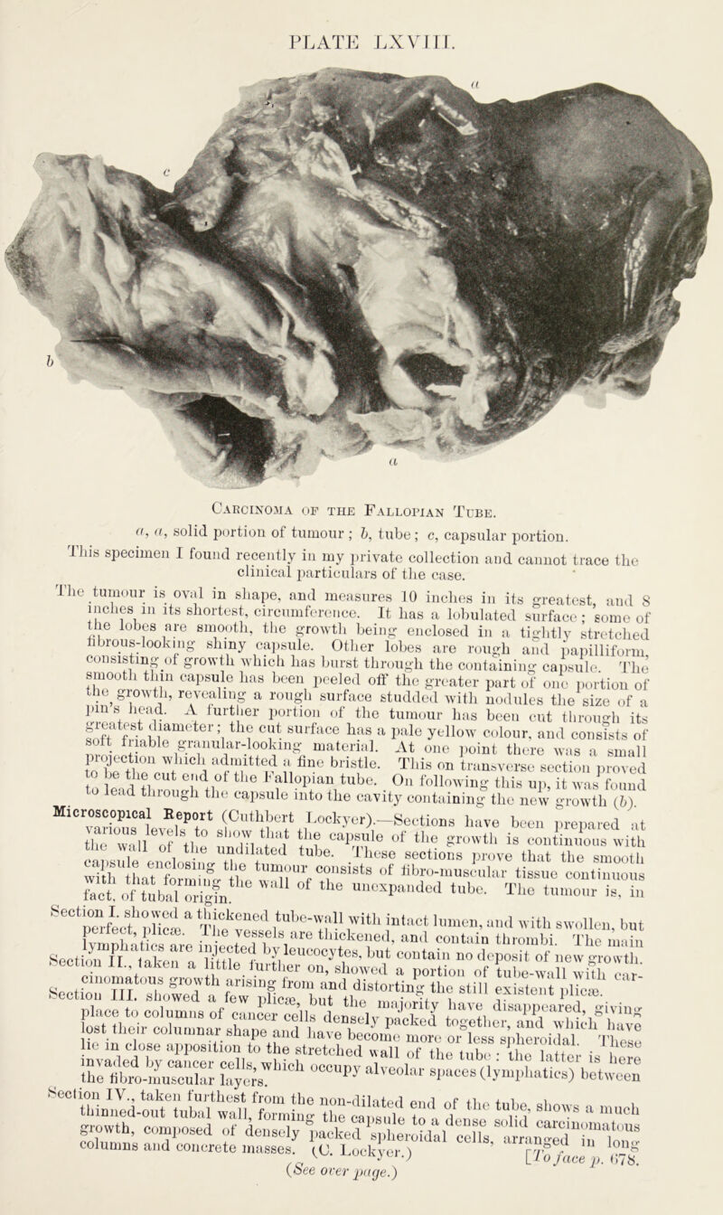 Carcinoma of the Fallopian Tube. a, a, solid portion of tumour ; b, tube; c, capsular portion. This specimen I found recently in my private collection and cannot trace the clinical particulars of the case. I he tumour is oval in shape, and measures 10 inches in its greatest and 8 inches m its shortest, circumference. It has a lobulated surface; some of the lobes are smooth, the growth being enclosed in a tightly stretched fibrous-looking shiny capsule. Other lobes are rough and papilliform consisting of growth which has burst through the containing capsule. The smooth thin capsule has been peeled off the greater part of one portion of the, growth, revealing a rough surface studded with nodules the size of a pm s head. A further portion of the tumour has been cut through its ?oft f?i m er:i h? surface has a pale yellow colour, and consists of so t friable granular-looting material. At one point there was a small o be tlTcWr a “ r?, id f, fln° bristle' TMs 011 transverse section proved m La th? 7! „ Fallopian tube. On following this up, it was found o lead through the capsule into the cavity containing the new growth (6) Microscopical Report (Cuthbert Lockyer).-Sections have been prepared at the “wall 6of Stlt0 8 '°ri ‘L* r1*? caPrs,ule of the growth is continuous with i i Ve un(Elated tube. These sections prove that the smooth withU Ltn?n lg tUn}?Uri consists of fibro-muscular tissue continuous it of tibairrgithe aU °f tke UnCXpaaded tabe- T1.0 tumour is.°in SeeL“rLfXm a Thek?eL,tU''e-VIfn ,WttU jDtact hl““> ad with swollen, but 1 ect, plicae. 1 he vessels are thickened, and contain thrombi The main Sect oTfl amkenrea‘X 1 ^ contain no depo^ f new L>“‘ -3=r' - ^“'riuLed-LtLbalL?!!,1for^ng ^“e to'’ 1 ‘ft B‘10WS a “uch growth, composed of densely ^ked^t^ftua LrrauTdTf''18 columns and concrete masses. (C. Lockver 1 ’ ' rv° •  long w. J-uuKyei.; liojacep. 678.