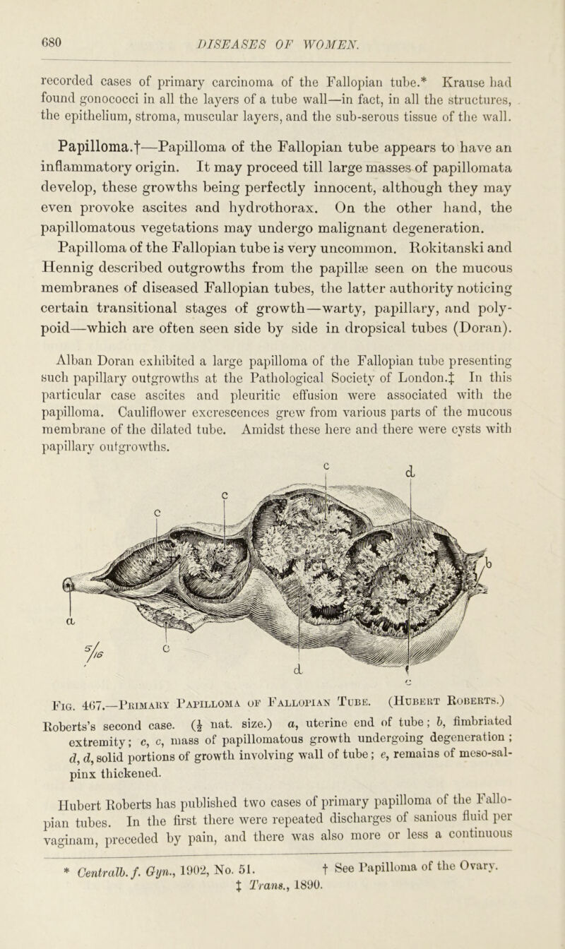 recorded cases of primary carcinoma of the Fallopian tube.* Krause had found gonococci in all the layers of a tube wall—in fact, in all the structures, the epithelium, stroma, muscular layers, and the sub-serous tissue of the wall. Papilloma.t—Papilloma of the Fallopian tube appears to have an inflammatory origin. It may proceed till large masses of papillomata develop, these growths being perfectly innocent, although they may even provoke ascites and hydrothorax. On the other hand, the papillomatous vegetations may undergo malignant degeneration. Papilloma of the Fallopian tube is very uncommon. Rokitanski and Hennig described outgrowths from the papillae seen on the mucous membranes of diseased Fallopian tubes, the latter authority noticing certain transitional stages of growth—warty, papillary, and poly- poid—which are often seen side by side in dropsical tubes (Doran). Alban Doran exhibited a large papilloma of the Fallopian tube presenting such papillary outgrowths at the Pathological Society of London.^ In this particular case ascites and pleuritic effusion were associated with the papilloma. Cauliflower excrescences grew from various parts of the mucous membrane of the dilated tube. Amidst these here and there were cysts with papillary outgrowths. Fig. 467. Primary Papilloma of Fallopian Tube. (Hubert Roberts.) Roberts’s second case. (J nat. size.) a, uterine end of tube ; b, fimbriated extremity; c, c, mass of papillomatous growth undeigoing degeneration , d, d, solid portions of growth involving wall of tube; e, remains of meso-sal- pinx thickened. Hubert Roberts has published two cases of primary papilloma of the Fallo- pian tubes. In the first there were repeated discharges of sanious fluid per vaginam, preceded by pain, and there was also more or less a continuous * Centralb. f. Gyn1902, No. 51. t See Papilloma of the Ovary. X Trans., 1890.