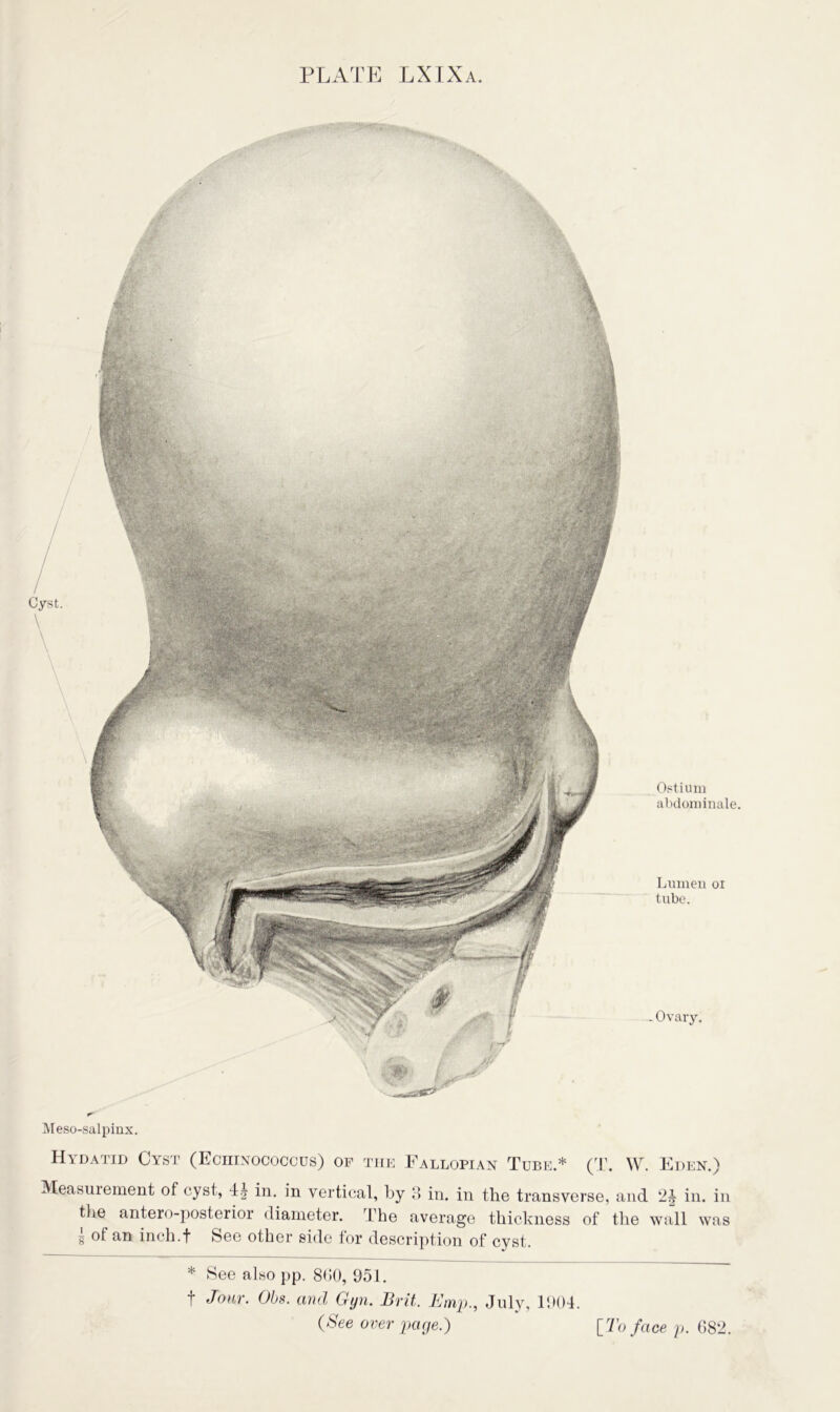 PLATE LXIXa Ostium abdominale. Lumen oi tube. .Ovary. Mesosalpinx. Hydatid Cyst (Echinococcus) of the Fallopian Tube.* (T. W. Eden.) Measurement of cyst, 4| in. in vertical, by 3 in. in the transverse, and 2J in. in the antero-posterior diameter. The average thickness of the wall was g of an inch.f See other side for description of cyst. * See also pp. 8(i0, 951. f Jour. Ohs. and Gyn. Brit. Emp., July, 1904.