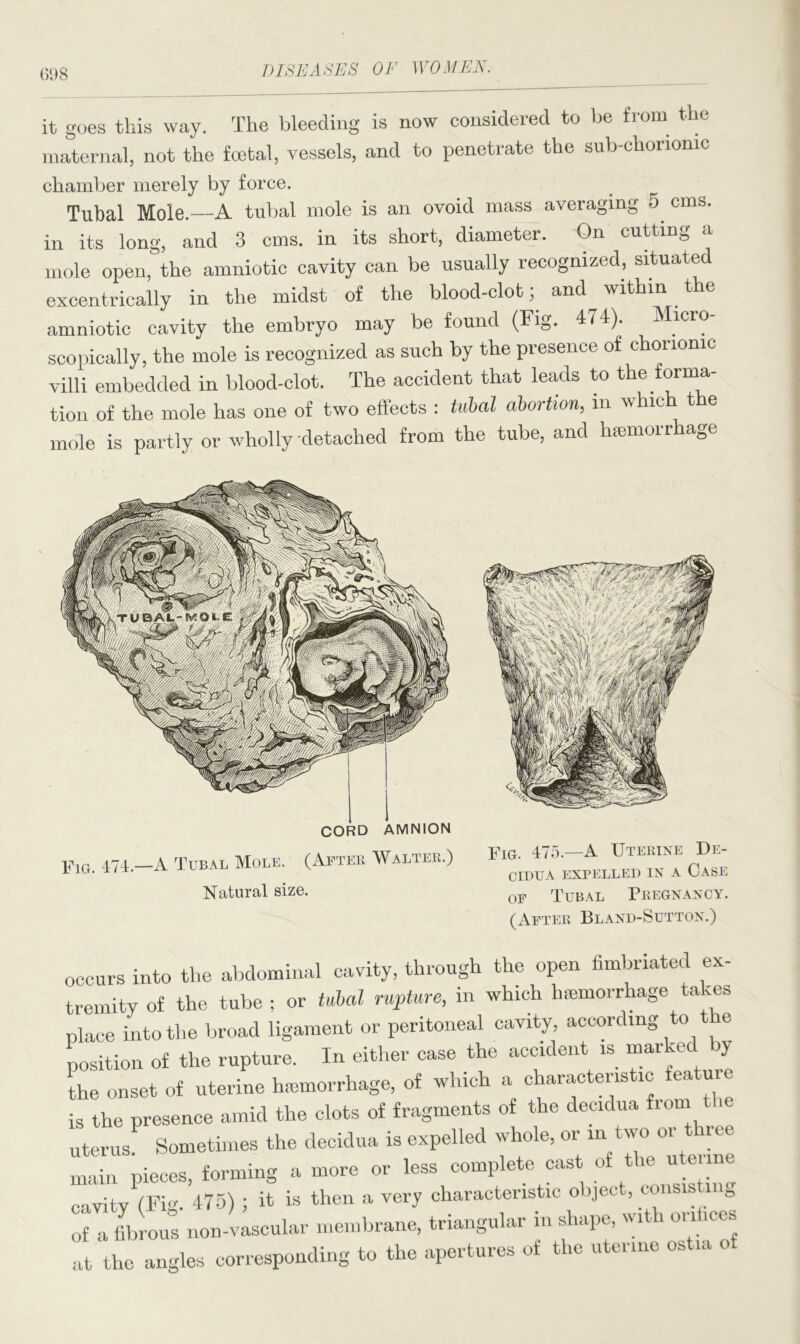 (598 it goes this way. The bleeding is now considered to be from the maternal, not the foetal, vessels, and to penetrate the sub-chonomc chamber merely by force. Tubal Mole.—A tubal mole is an ovoid mass averaging 5. cms. in its long, and 3 cms. in its short, diameter. On cutting a mole open, the amniotic cavity can be usually recognized, situated excentrically in the midst of the blood-clot; and within the amniotic cavity the embryo may be found (Fig. 474). Micro scopically, the mole is recognized as such by the presence of chorionic villi embedded in blood-clot. The accident that leads to the forma- tion of the mole has one of two effects : tubal abortion,, in which the mole is partly or wholly detached from the tube, and hemorrhage CORD AMNION Fig. 474-—A Tubal Mole. (After Walter.) Natural size. Fig. 475.—A Uterine De- cidua EXPELLED IN A CASE of Tubal Pregnancy. (After Bland-Sutton.) occurs into the abdominal cavity, through the open fimbriated ex- tremity of the tube ; or tubal rupture, in which haemorrhage takes place into the broad ligament or peritoneal cavity, according to e position of the rupture. In either case the accident is marked by the onset of uterine haemorrhage, of which a characteristic feature is the presence amid the clots of fragments of the decidua fiom uterus. Sometimes the decidua is expelled whole, or m two or thi ee main pieces, forming a more or less complete cast of cavity (Fig. 475) ; it is then a very characteristic object, eonsis mg of a fibrous non-vascular membrane, triangular in shape, with orifices at the angles corresponding to the apertures of the uterine ostia