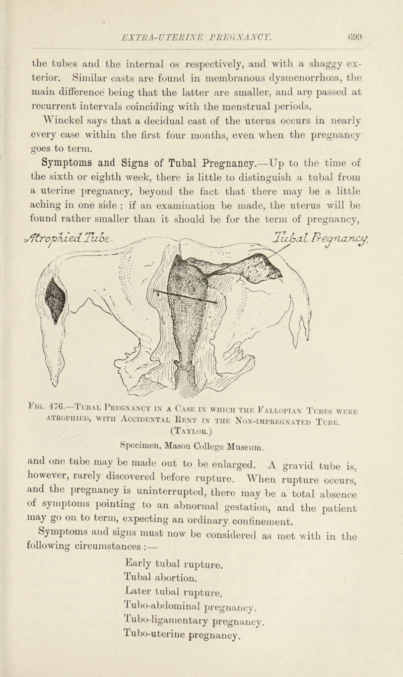 the tubes and the internal os respectively, and with a shaggy ex- terior. Similar casts are found in membranous dysmenorrhcea, the main difference being that the latter are smaller, and are passed at recurrent intervals coinciding with the menstrual periods. Winckel says that a decidual cast of the uterus occurs in nearly every case within the first four months, even when the pregnancy goes to term. Symptoms and Signs of Tubal Pregnancy.—Up to the time of the sixth or eighth week, there is little to distinguish a tubal from a uterine pregnancy, beyond the fact that there may be a little aching in one side ; if an examination be made, the uterus will be found rather smaller than it should be for the term of pregnancy, Fig. 476.—Tubal Pregnancy in a Case in which the Fallopian ATROPHIED, WITH ACCIDENTAL RENT IN THE NoN-IMPREGNATE Tubes were d Tube. (Taylor.) Specimen, Mason College Museum. and one tube may be made out to be enlarged. A gravid tube is, however, rarely discovered before rupture. When rupture occurs,’ and the pregnancy is uninterrupted, there may be a total absence of symptoms pointing to an abnormal gestation, and the patient may go on to term, expecting an ordinary confinement. Symptoms and signs must now be considered as met with in the following circumstances:— Early tubal rupture. Tubal abortion. Later tubal rupture. Tubo-abdominal pregnancy. 1 ubo-ligamentary pregnancy. I ubo-uterine pregnancy.