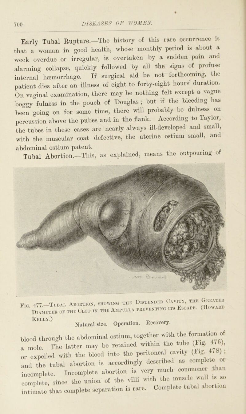 700 Early Tubal Rupture.—The history of this rare occurrence is that a woman in good health, whose monthly period is about a week overdue or irregular, is overtaken by a sudden pain and alarming collapse, quickly followed by all the signs of profuse internal lisemorrhage. If surgical aid be not forthcoming, the patient dies after an illness of eight to forty-eight hours’ duration. On vaginal examination, there may be nothing felt except a vague boggy fulness in the pouch of Douglas; but if the bleeding has been going on for some time, there will probably be dulness on percussion above the pubes and in the flank. According to Taylor, the tubes in these eases are nearly always ill-developed and small, with the muscular coat defective, the uterine ostium small, and abdominal ostium patent. Tubal Abortion.—This, as explained, means the outpouring ot Fig. 477. Tubal Abortion, showing the Diameter of the Clot in the Ampulla Distended Cavity, the Greater preventing its Escape. (Howard Kelly.) Natural size. Operation. Recovery. blood through the abdominal ostium, together with the formation of a mole. The latter may be retained within the tube (Fig. ), or expelled with the blood into the peritoneal cavity (Iig. and the tubal abortion is accordingly described as complete or incomplete. Incomplete abortion is very much commoner .than complete, since the union of the villi with the muscle wall is so intimate that complete separation is rare. Complete tubal abortion