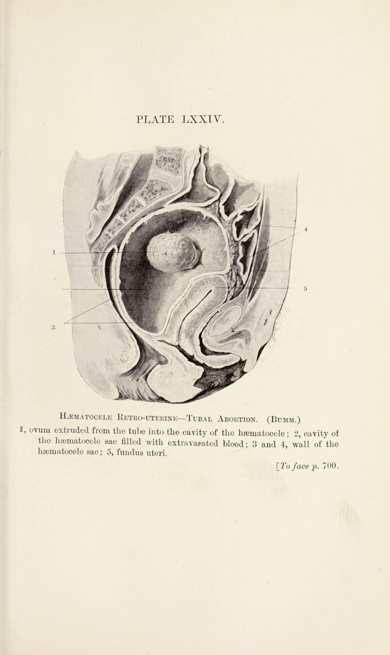 Hematocele Retro-uterine—Tubal Abortion. (Bumm.) ovum extiuded from tire tube into the cavity of tlie hsematocele ; 2, cavity of the hsematocele sac filled with extravasated blood; 3 and 4, wall of the hsematocele sac; 5, fundus uteri. [To face p. 700.