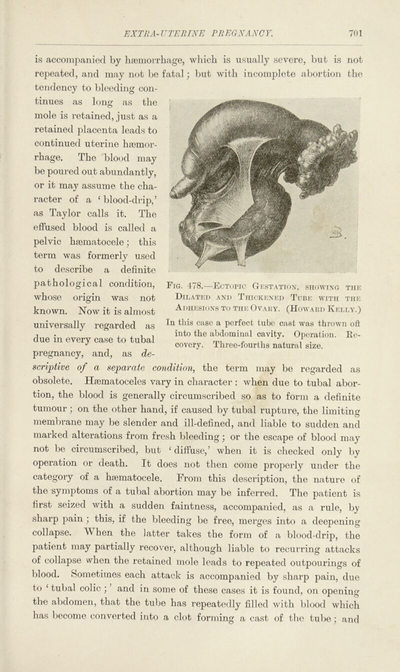 is accompanied by haemorrhage, which is usually severe, but is not repeated, and may not be fatal; but with incomplete abortion the tendency to bleeding con- tinues as long as the mole is retained, just as a retained placenta leads to continued uterine haemor- rhage. The blood may be poured out abundantly, or it may assume the cha- racter of a * blood-drip,’ as Taylor calls it. The effused blood is called a pelvic haematocele; this term was formerly used to describe a definite pathological condition, whose origin was not known. Now it is almost universally regarded as due in every case to tubal pregnancy, and, as de- Fig. 478.—Ectopic Gestation, showing the Dilated and Thickened Tube with the Adhesions to the Ovary. (Howard Kelly.) In this case a perfect tube cast was thrown oft into the abdominal cavity. Operation. Re- covery. Three-fourths natural size. seriptive of a separate condition, the term may be regarded as obsolete. Hiematoceles vary in character : when due to tubal abor- tion, the blood is generally circumscribed so as to form a definite tumour; on the other hand, if caused by tubal rupture, the limiting membrane may be slender and ill-defined, and liable to sudden and marked alterations from fresh bleeding; or the escape of blood may not be circumscribed, but £ diffuse,’ when it is checked only by operation or death. It does not then come properly under the category of a haematocele. From this description, the nature of the symptoms of a tubal abortion may be inferred. The patient is first seized with a sudden faintness, accompanied, as a rule, by sharp pain ; this, if the bleeding be free, merges into a deepening collapse. W hen the latter takes the form of a blood-drip, the patient may partially recover, although liable to recurring attacks of collapse when the retained mole leads to repeated outpourings of blood. Sometimes each attack is accompanied by sharp pain, due to ‘ tubal colic ; ’ and in some of these cases it is found, on opening thn abdomen, that the tube has repeatedly filled with blood which has become converted into a clot forming a cast of the tube ; and