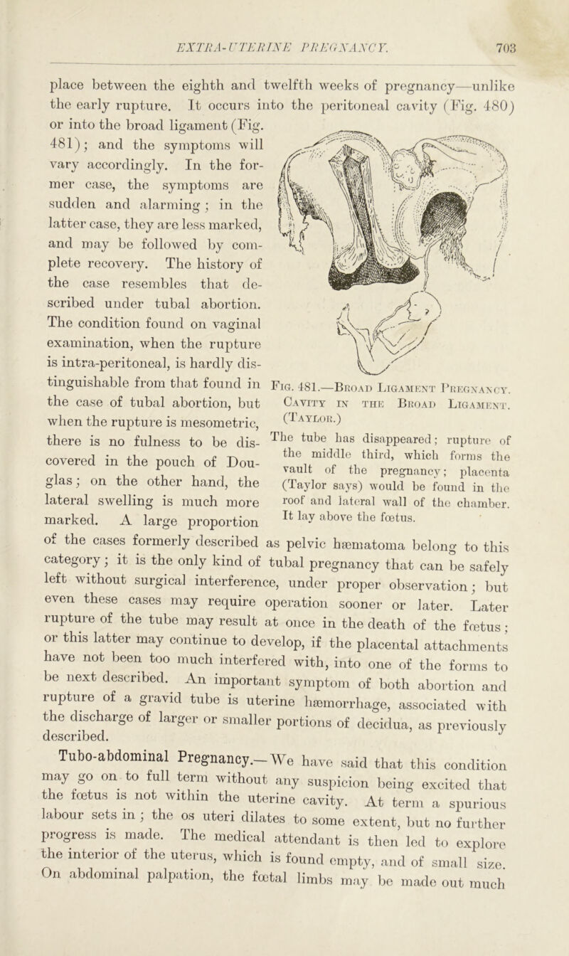 place between the eighth and twelfth weeks of pregnancy—unlike the early rupture. It occurs into the peritoneal cavity (Fig. 480) or into the broad ligament (Fig. 481); and the symptoms will vary accordingly. In the for- mer case, the symptoms are J| sudden and alarming; in the latter case, they are less marked, and may be followed by com- plete recovery. The history of the case resembles that de- scribed under tubal abortion. The condition found on vaginal examination, when the rupture is intra-peritoneal, is hardly dis- tinguishable from that found in Fib. 481.—BroaiTligament Pregnancy. the case of tubal abortion, but Cavity ix the Broad Ligament. when the rupture is mesometric, (* AYLOR0 there is no fulness to be dis- tube has disappeared; rupture of covered in the pouch of Dou- the middle third, which forms the vault of the pregnancy; placenta (Taylor says) would be found in the root and lateral wall of the chamber. It lay above the foetus. glas; on the other hand, the lateral swelling is much more marked. A large proportion of the cases formerly described as pelvic hasmatoma belong to this category; it is the only kind of tubal pregnancy that can be safely left without surgical interference, under proper observation ; but even these cases may require operation sooner or later. Later rupture of the tube may result at once in the. death of the foetus: or this latter may continue to develop, if the placental attachments have not been too much interfered with, into one of the forms to be next described. An important symptom of both abortion and rupture of a gravid tube is uterine haemorrhage, associated with the discharge of larger or smaller portions of decidua, as previously described. Tubo-abdominal Pregnancy.—We have said that this condition may go on to full term without any suspicion being excited that the foetus is not within the uterine cavity. At term a spurious labour sets in ; the os uteri dilates to some extent, but no further progress is made. The medical attendant is then led to explore the interior of the uterus, which is found empty, and of small size On abdominal palpation, the foetal limbs may be made out much