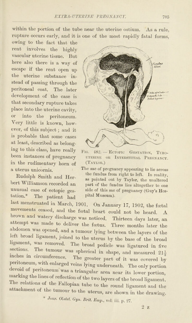 within the portion of the tube near the uterine ostium. As a rule, rupture occurs early, and it is one of the most rapidly fatal forms, owing to the fact that the rent involves the highly vascular uterine tissue. But here also there is a way of escape if the rent open up the uterine substance in- stead of passing through the peritoneal coat. The later development of the case is that secondary rupture takes place into the uterine cavity, or into the peritoneum. Very little is known, how- ever, of this subject; and it is probable that some cases at least, described as belong- ing to this class, have really been instances of pregnancy in the rudimentary horn of a uterus unicornis. Rudolph Smith and Her- bert Williamson recorded an unusual case of ectopic ges- tation/ The patient had last menstruated in March, 1901. On January 17, 1902, the fcetal movements ceased, and the fcetal heart could not be heard. A brown and watery discharge was noticed. Thirteen days later, an attempt was made to deliver the foetus. Three months later the a domen was opened, and a tumour lying between the layers of the left broad ligament, joined to the uterus by the base of the broad igament, was removed. The broad pedicle was ligatured in live * °nS.‘ . e *,umoul was spherical in shape, and measured 21-1 inches in circumference. The greater part of it was covered by peritoneum, with enlarged veins lying underneath. The only portion evcu o peritoneum was a triangular area near its lower portion, marking the lines of reflection of the two layers of the broad ligament. The relations of the Fallopian tube to the round ligament and the attachment of the tumour to the uterus, are shown in the drawing, o * Jour. OLstet. Gyn. Brit Emp., yol: Hi. p. 27. Fig. 482. — Ectopic Gestation, Tibo- UTERINE OR INTERSTITIAL PREGNANCY. (Taylor.) The sac of pregnancy appearing to lie across the fundus from right to left. In reality, as pointed out by Taylor, the unaltered part of the fundus lies altogether to one side of this sac of pregnancy (Guy’s Hos- pital Museum).