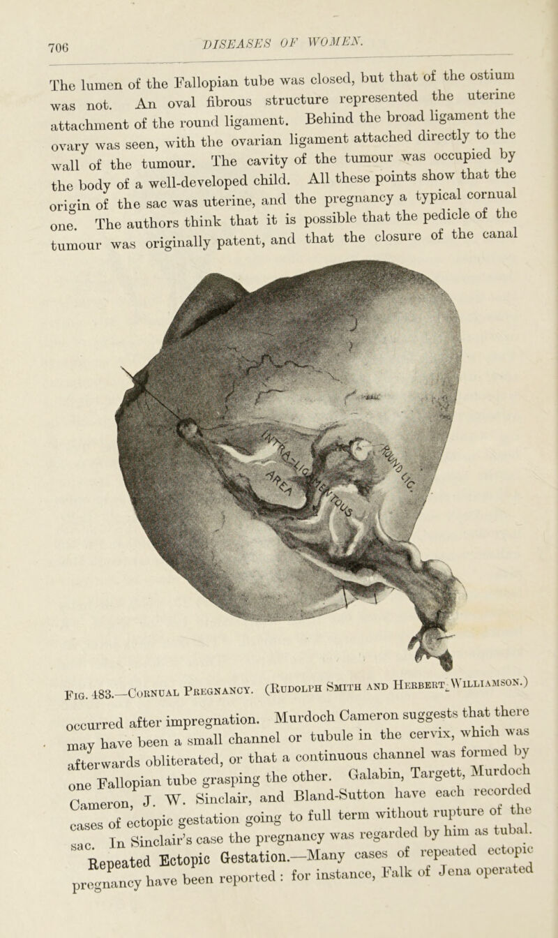 The lumen of the Fallopian tube was closed, but that of the ostium was not. An oval fibrous structure represented the uterine attachment of the round ligament. Behind the broad ligament the ovary was seen, with the ovarian ligament attached directly to e wall of the tumour. The cavity of the tumour was occupied by the body of a well-developed child. All these points show that the origin of the sac was uterine, and the pregnancy a typica cornual one. The authors think that it is possible that the pedicle of the tumour was originally patent, and that the closure of the canal Fig. 483.—Cornual Pregnancy. (Rudolph Smith and Herbert^Williamson.) occurred after impregnation. Murdoch Cameron suggests that there may have been a small channel or tubule in the cervix, which was afterwards obliterated, or that a continuous channel was formed by one Fallopian tube grasping the other. Galabm, Targett, i uic<x 1 Cameron, J. W. Sinclair, and Bland-Sutton have each recorded cases of ectopic gestation going to full term without rupture ot t u sac In Sinclair’s case the pregnancy was regarded by him as tu a . “ Repeated Ectopic Gestation.-Many cases of repeated ectopic pregnancy have been reported : for instance, Falk of Jena operate