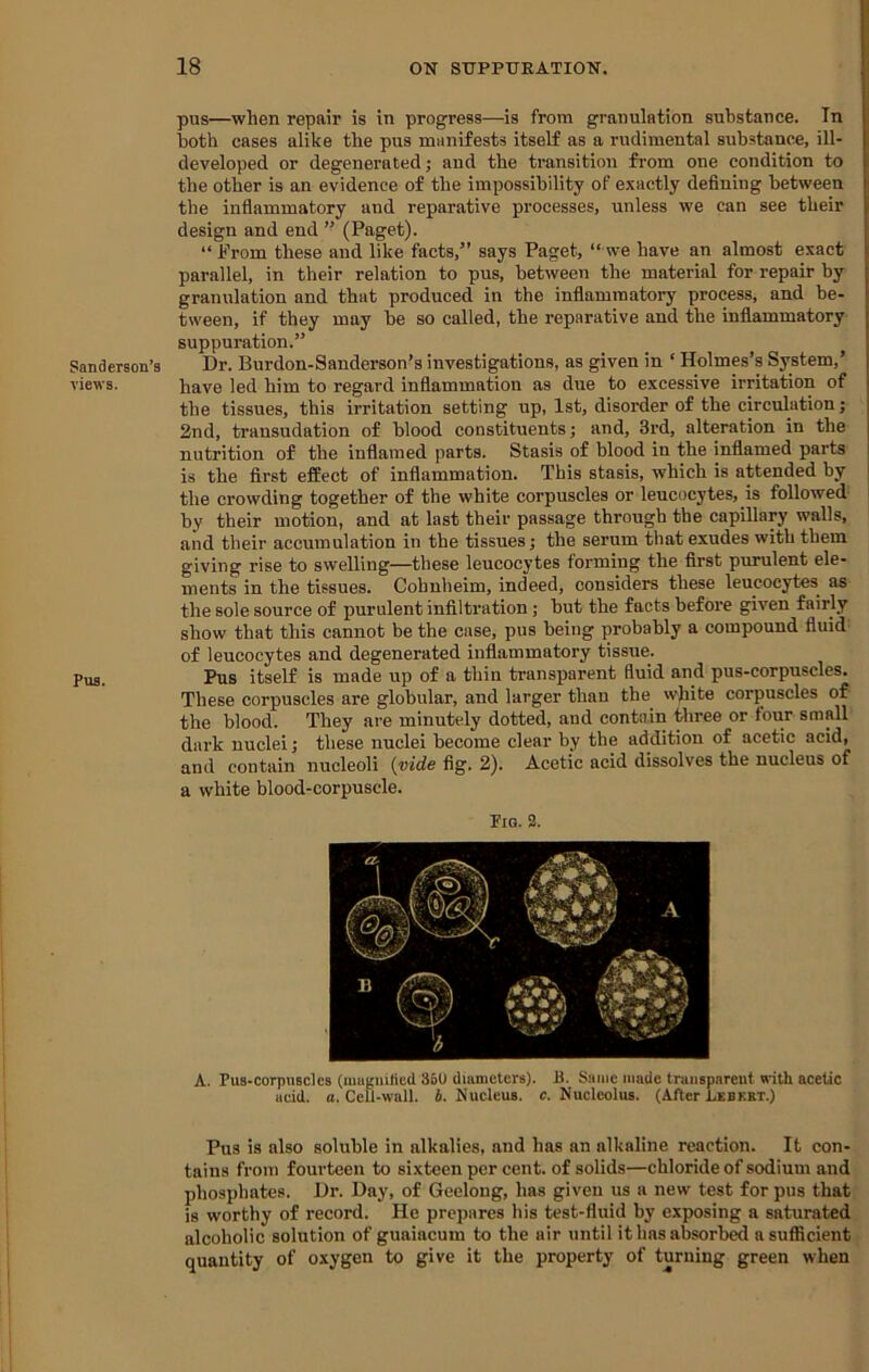 Sanderson’s views. Pus. pus—when repair is in progress—is from granulation substance. In both cases alike the pus manifests itself as a rudimental substance, ill- developed or degenerated; and the transition from one condition to the other is an evidence of the impossibility of exactly defining between the inflammatory and reparative processes, unless we can see their design and end ” (Paget). “From these and like facts,” says Paget, “ we have an almost exact parallel, in their relation to pus, between the material for repair by granulation and that produced in the inflammatory process, and be- tween, if they may he so called, the reparative and the inflammatory suppuration.” Dr. Burdon-Sanderson’s investigations, as given in ‘ Holmes’s System,’ have led him to regard inflammation as due to excessive irritation of the tissues, this irritation setting up, 1st, disorder of the circulation; 2nd, transudation of blood constituents; and, 3rd, alteration in the nutrition of the inflamed parts. Stasis of blood in the inflamed parts is the first eflEect of inflammation. This stasis, which is attended by the erowding together of the white corpuscles or leucocytes, is followed by their motion, and at last their passage through the capillary walls, and their accumulation in the tissues; the serum that exudes with them giving rise to swelling—these leucocytes forming the first purulent ele- ments in the tissues. Cohnheim, indeed, eonsiders these leucocytes as the sole source of purulent infiltration; hut the facts before given fairly show that this cannot be the case, pus being probably a compound fluid of leucocytes and degenerated inflammatory tissue. Pus itself is made up of a thin transparent fluid and pus-corpuscles. These corpuscles are globular, and larger than the white corpuscles of the blood. They are minutely dotted, and contain three or tour small dark nuclei; these nuclei become clear by the addition of acetic acid, and contain nucleoli {vide fig. 2). Acetic acid dissolves the nucleus of a white blood-corpuscle. I'm. 2. A. Pus-corpiiBcles (magnified 350 diameters). B. Same made transparent with acetic acid. a. Cell-wall. b. Nucleus, c. Nucleolus. (After Lebkbt.) Pus is also soluble in alkalies, and has an alkaline reaction. It con- tains from fourteen to sixteen per cent, of solids—chloride of sodium and phosphates. Dr. Day, of Geelong, has given us a new test for pus that is worthy of record. He prepares his test-fluid by exposing a saturated alcoholic solution of guaiacum to the air until it has absorbed a sufficient quantity of oxygen to give it the property of turning green when