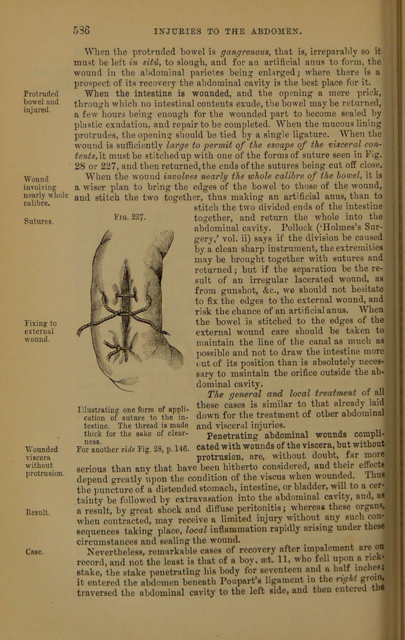 Protruded bowel and injured. Wound involving nearly whole calibre. Sutures. Fixing to external wound. Wounded viscera without protrusion. Result. Case. Fig. 327. When the protruded bowel is gangrenous, that is, irreparably so it must be left in sit4, to slough, and for an artificial anus to form, the wound in the abdominal parietes being enlarged; where there is a prospect of its recovery the abdominal cavity is the best place for it. WTien the intestine is wounded, and the opening a mere prick, through which no intestinal contents exude, the bowel may be returned, a few hours being enough for the wounded part to become sealed by plastic exudation, and repair to be completed. When the mucous lining protrudes, the opening should be tied by a single ligature. When the wound is sufficiently large to permit of the escape of the visceral con- tents,it must be stitched up with one of the forms of suture seen in Fig. 28 or 227, and then returned, the ends of the sutures being cut off close. When the wound involves nearly the whole calibre of the bowel, it is a wiser plan to bring the edges of the bowel to those of the wound, and stitch the two together, thus making an artificial anus, than to stitch the two divided ends of the intestine together, and return the whole into the abdominal cavity. Pollock (‘Holmes’s Sur- gery,’ vol. ii) says if the division be caused by a clean sharp instrument, the extremities may be brought together with sutures and returned; but if the separation be the re- sult of an irregular lacerated wound, as from gunshot, &c., we should not hesitate to fix the edges to the external wound, and risk the chance of an artificial anus. “When the bowel is stitched to the edges of the external wound care should be taken to maintain the line of the canal as much as ])Ossible and not to draw the intestine raorej cut of its position than is absolutely neces- sary to maintain the orifice outside the ab- dominal cavity. The general and local treatment of all these cases is similar to that already laid down for the treatment of other abdominal and visceral injuries. Penetrating abdominal wounds compli- cated with wounds of the viscera, but without protrusion, are, without doubt, far more serious than any that have been hitherto considered, and depend greatly upon the condition of the viscus when wounded. Thus the puncture of a distended stomach, intestine, or bladder, will to a cer- tainty be followed by extravasation into the abdominal cavity, and, as a result, by great shock and dittuse peritonitis; whereas these organs,^ when contracted, may receive a limited injury without any such con- sequences taking place, local inflammation rapidly arising under tbes circumstances and sealing the wound. - . , i Nevertheless, remarkable cases of recovery after impalement are on record, and not the least is that of a boy, mt. 11, who fell upon a ''‘ck- stake, the stake penetrating his body for seventeen and a half inches, it entered the abdomen beneath Poupart’s ligament in the rtghi * traversed the abdominal cavity to the left side, and then entered Illustrating: one form of appli- cation of suture to the in- testine. The thread is made thick for the sake of clear- ness. For another vide Fig. 28, p. 146.