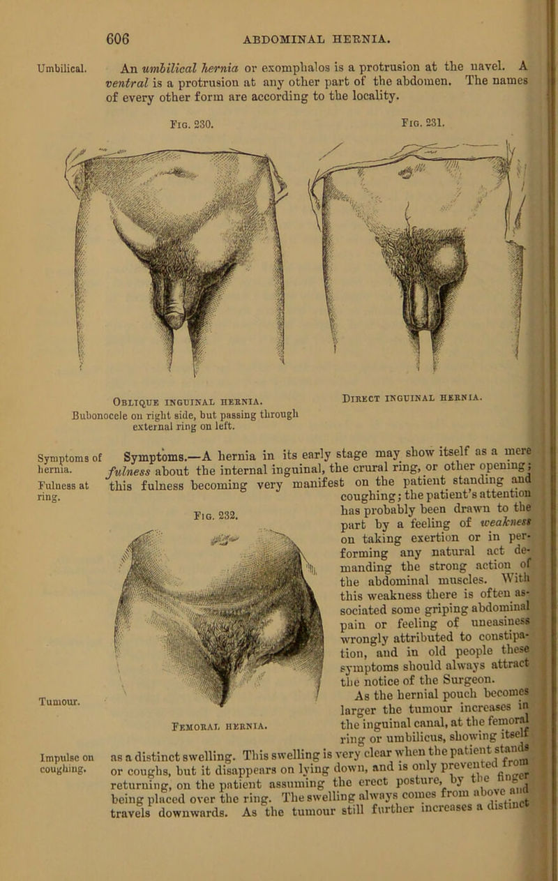 Umbilical. An umbilical hernia or exomphalos is a protrusion at the navel. A ventral is a protrusion at any other part of the abdomen. The names of every other form are according to the locality. Fig. 230. Fig. 231. Obltque inguinal heunia. Bubonocele on right side, but passing through external ring on left. Direct inguinal hernia. Symptoms of Symptoms.—A hernia in its early stage may show itself as a mere hernia. fulness about the internal inguinal, the crural ring, or other opening; Fulness at ring. Fig. 232. Tumour. Femoral hernia. manifest on the patient standing and coughing; the patient’s attention has probably been drawn to the part by a feeling of weakness on taking exertion or in per- forming any natural act de- manding the strong action of the abdominal muscles. With this weakness there is often as- sociated some griping abdominal pain or feeling of uneasinessi wrongly attributed to constipa- ’ tion, and in old people these symptoms should always attract the notice of the Surgeon. As the hernial pouch become. larger the tumour increases in the inguinal canal, at the femorm .. Impulse on coughing. ring or umbilicus, showing >• is very clear when the patient stands ^ as a distinct swelling. This swelling, c, j -—- - ——-. or coughs, but it disappears on lying down, and is only finffer' returning, on the patient assuming the erect posture, by , if being placed over the ring. The swelling always comes from «bovo a ^ ^ travels downwards. As the tumour still further increases a