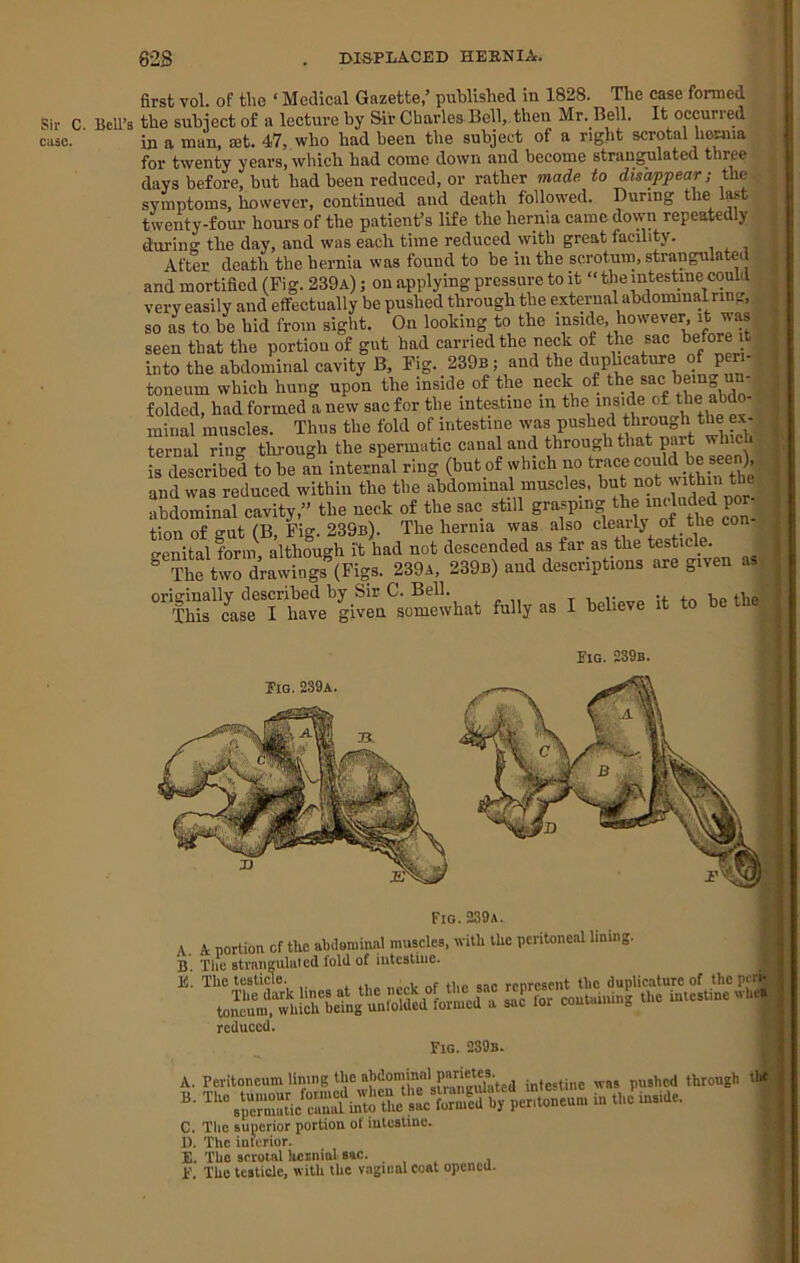 Sir C case. first vol. of tlio ‘ Medical Gazette,’ published in 1828. The case formed Bell’s the subiect of a lecture by Sir Charles Bell, then Mr. Bell. It occurred in a man, mt. 47, who had been the subject of a right scrotal hoaua for twenty years, which had come down and become strangulated three days before, but had been reduced, or rather made to disappear; the symptoms, however, continued and death followed. During the lA't twenty-foul- hours of the patient’s life the hernia came down repeatedly during the day, and was each time reduced with great facility. After death the hernia was found to be in the scrotum, strangulated and mortified (Pi g. 239a) ; on applying pressure to it »the intestine could very easily and effectually be pushed through the external abdominalnng, so as to be hid from sight. On looking to the inside, however, it was seen that the portion of gut had carried the neck of the sac before it into the abdominal cavity B, Fig. 239b ; and the duphcature of peri- toneum which hung upon the inside of the neck of the sac being un folded, had formed a new sac for the intestine in the inside of the abdo- miiial muscles. Thus the fold of intestine was pushed through the ex- ternal ring through the spermatic canal and through that part which is described to be an internal ring (but of which no could be see^^^^^ and was reduced within the the abdominal muscles, not u thin^^^^^^^ abdominal cavity,” the neck of the sac still firm of ffut fB Fig. 239b). The hernia was also clcaily ot the con . genital form, although i't had not descended as far as the testicle. ^ Tt twJ drawingsVigB- 239a, 239b) and descriptions are given a , C^as^*rha4''given^^ fully as I believe it to be the^ Eio. 239b. Pig. 239a. C. The Bu^ierior portion of iulcsline. D. The interior. E. The serotnl lunminl 8»c. . , . , P. The testicle, with the vaginal coat opened. A. B. E. Fio. 239a OQOu portion of the ahiloniinal muscles, with the peritoneal lining, le stvnngululcd fold of intestine. reduced.