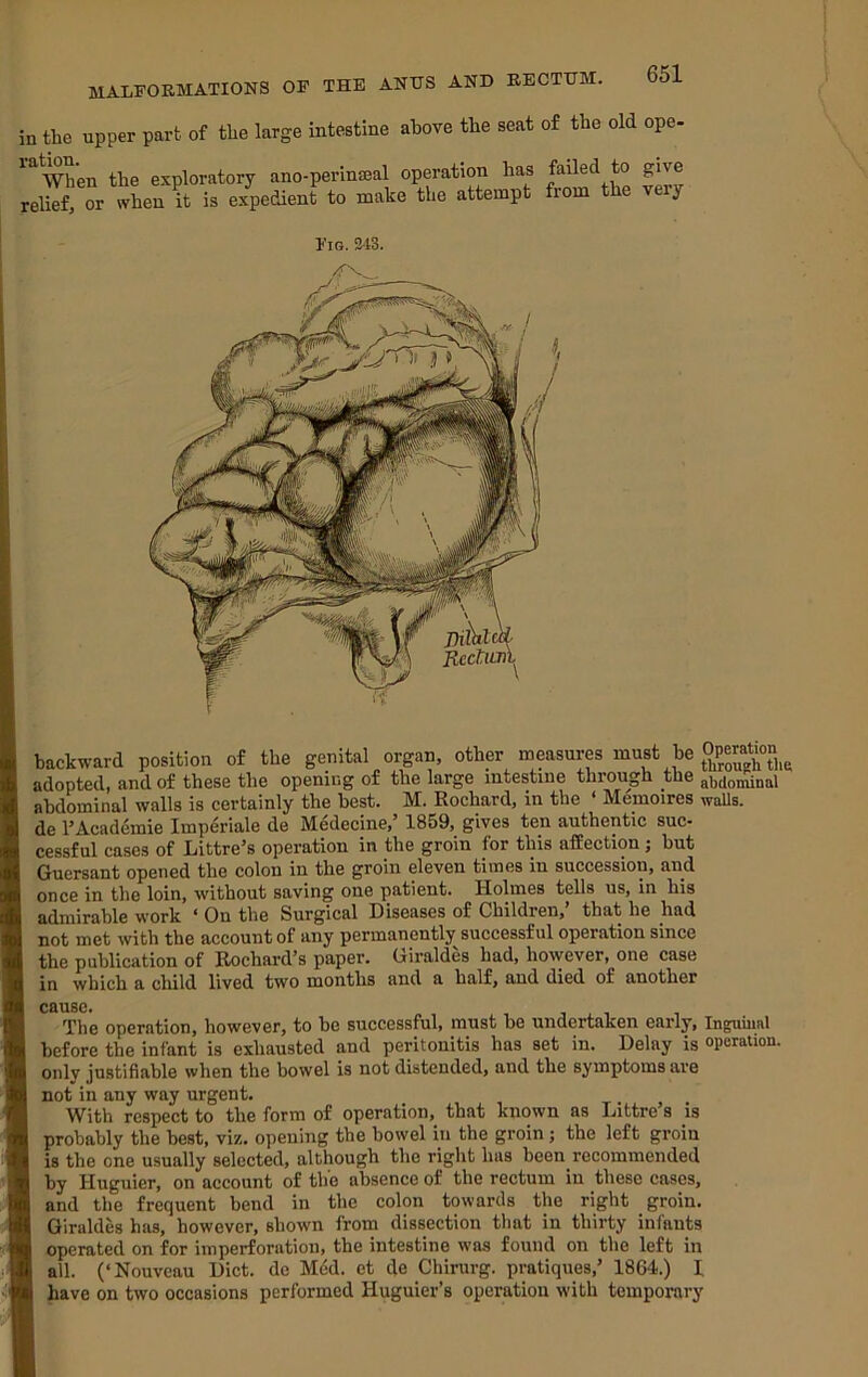 in the upper part of the large intestine above the seat of the old ope- '^When the exploratory ano-perinfflal operation has failed to give relief, or when it is expedient to make the attempt from the veiy Fig. 243. JlcduA backward position of the genital organ, other measures must he adopted, and of these the opening of the large intestine through the abdominal abdominal walls is certainly the best. IM. Rochard, in the Memoires walls, de 1’Academic Imperiale de Medecine,’ 1859, gives ten authentic suc- cessful cases of Littre’s operation in the groin for this affection ; but Gucrsant opened the colon in the groin eleven times in succession, and once in the loin, without saving one patient. Holmes tells us, in his admirable work ‘ On the Surgical Diseases of Children,’ that he had not met with the account of any permanently successful operation since the publication of Rochard’s paper. Oiraldes had, however, one case in which a child lived two months and a half, and died of another cause. The operation, however, to he successful, must be undertaken early, Inguiiial before the infant is exhausted and peritonitis has set in. Delay is operation, onlv justifiable when the bowel is not distended, and the symptoms are not in any way urgent. With respect to the form of operation, that known as Littre s is probably the best, viz. opening the bowel in the groin; the left groin is the one usually selected, although the right has been recommended by Huguier, on account of the absence of the rectum in these cases, and the frequent bend in the colon towards the right groin. Giraldes has, however, shown from dissection that in thirty infants operated on for imperforation, the intestine was found on the left in all. (‘Nouveau Diet, de Med. et de Chirurg. pratiques,’ 1864.) 1 have on two occasions performed Huguier’s operation with temporary